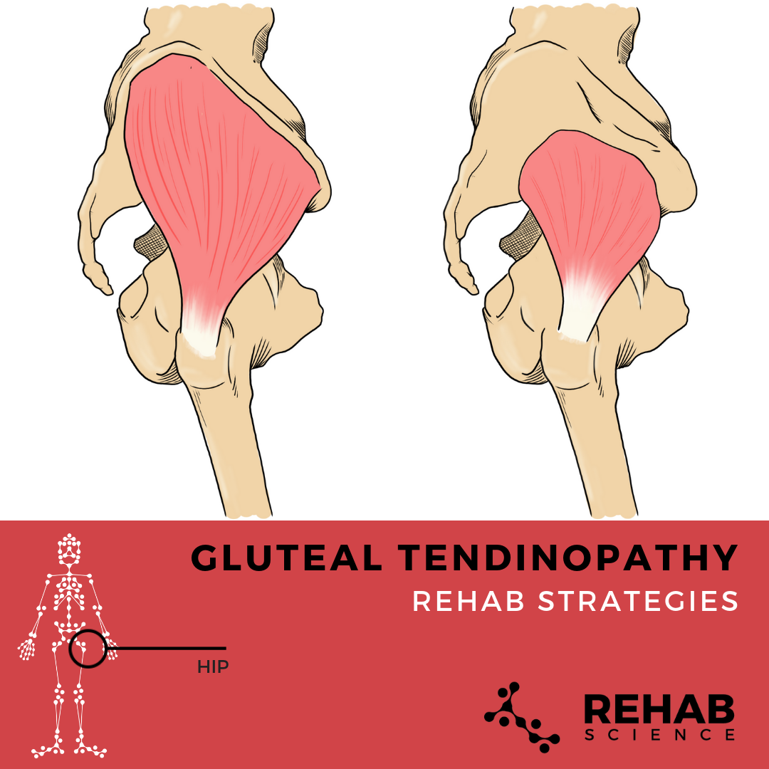 Gluteus Medius Tendinopathy