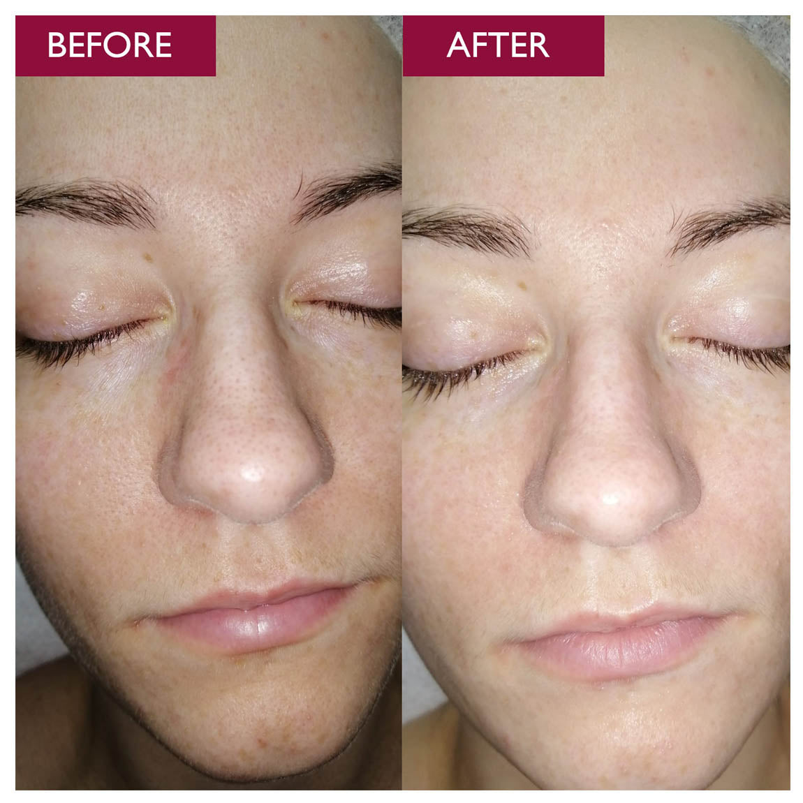 Glycolic Acid For Skin