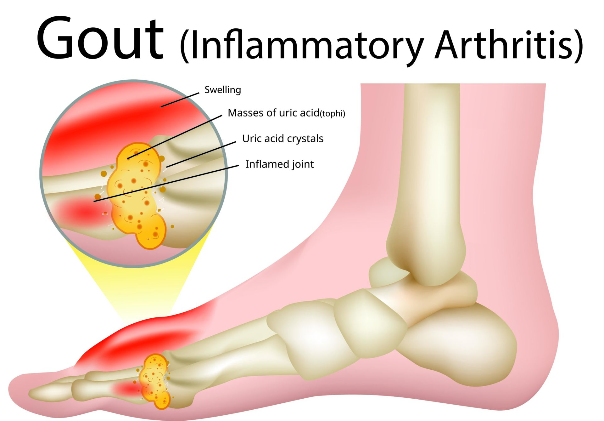 Gout And Ankle
