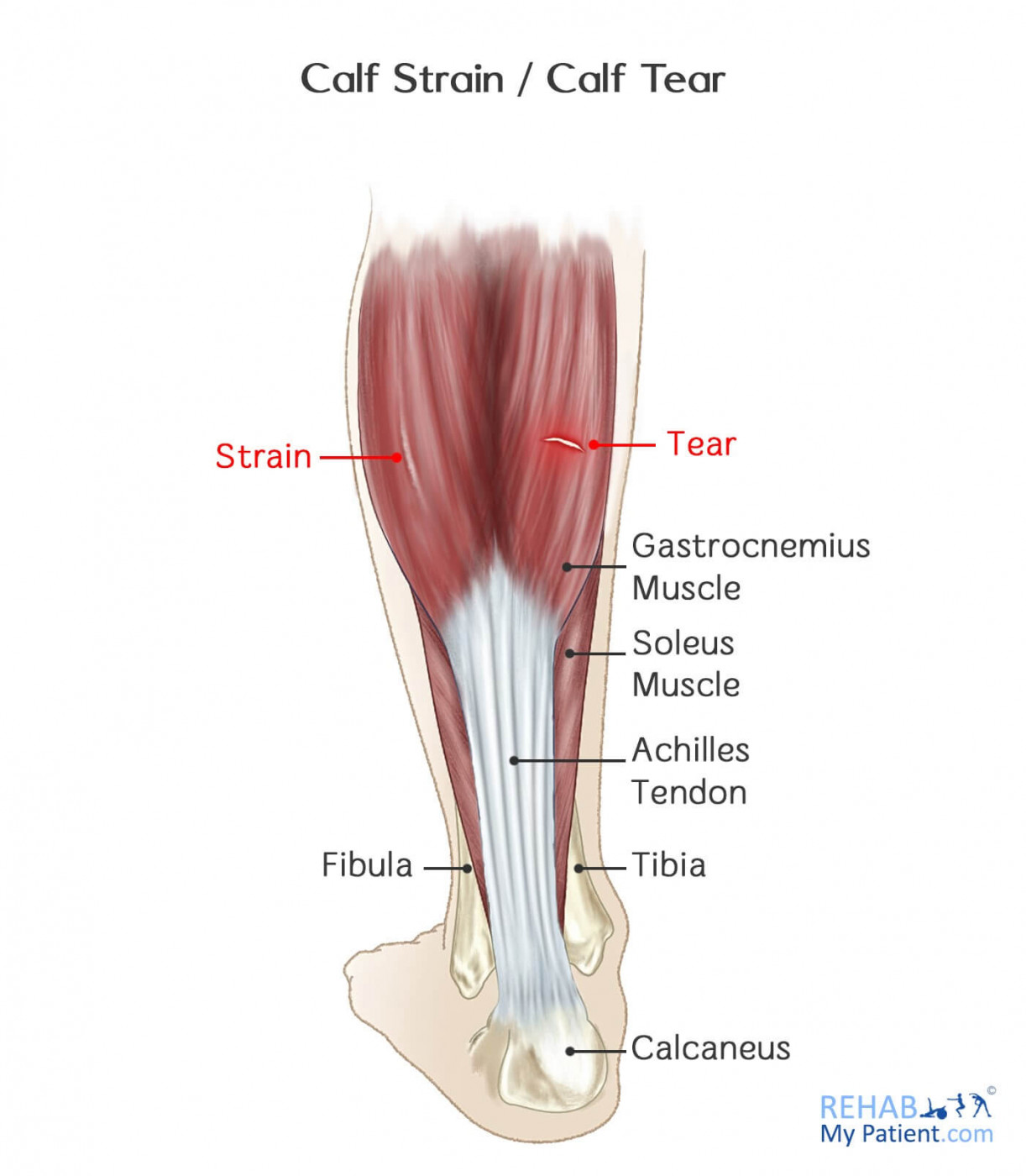 Grade 2 Left Gastrocnemius Strain