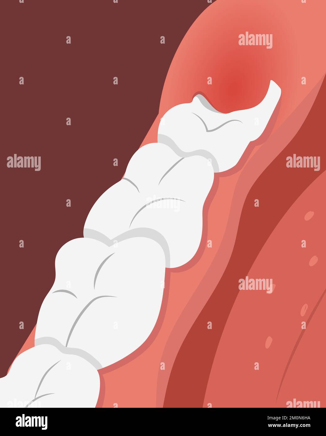 Growing Tooth In Gum
