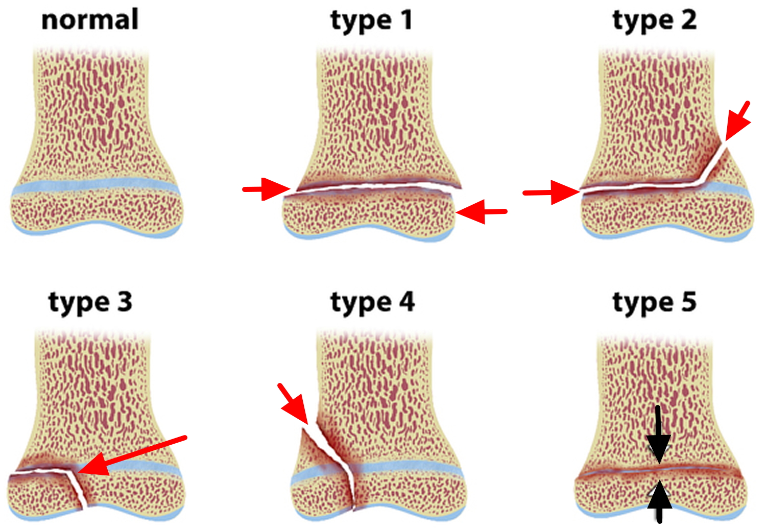 Growth Plate Fracture