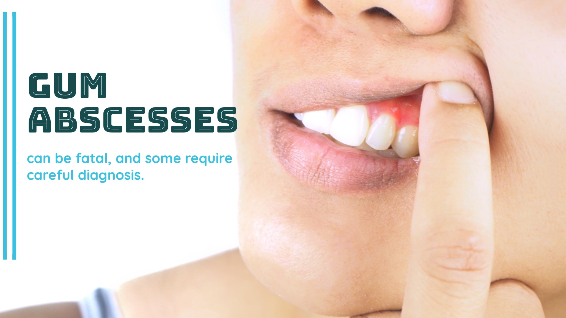Gum Abscess Pop