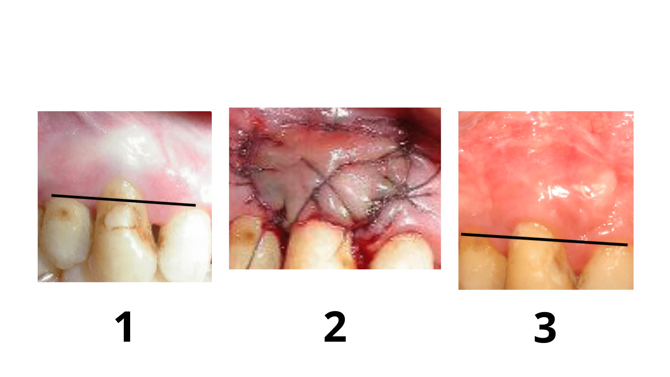 Gum Graft Surgery