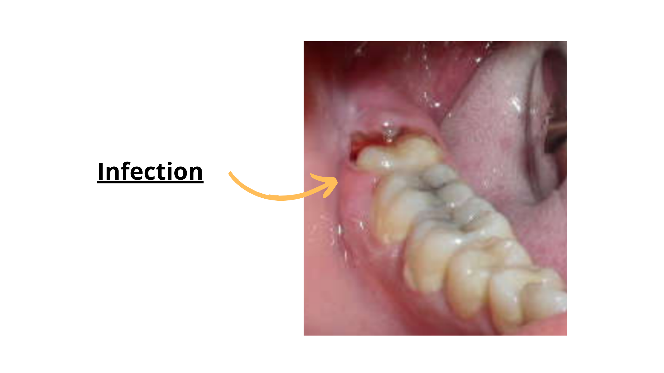 Gum Swelling Around Wisdom Teeth
