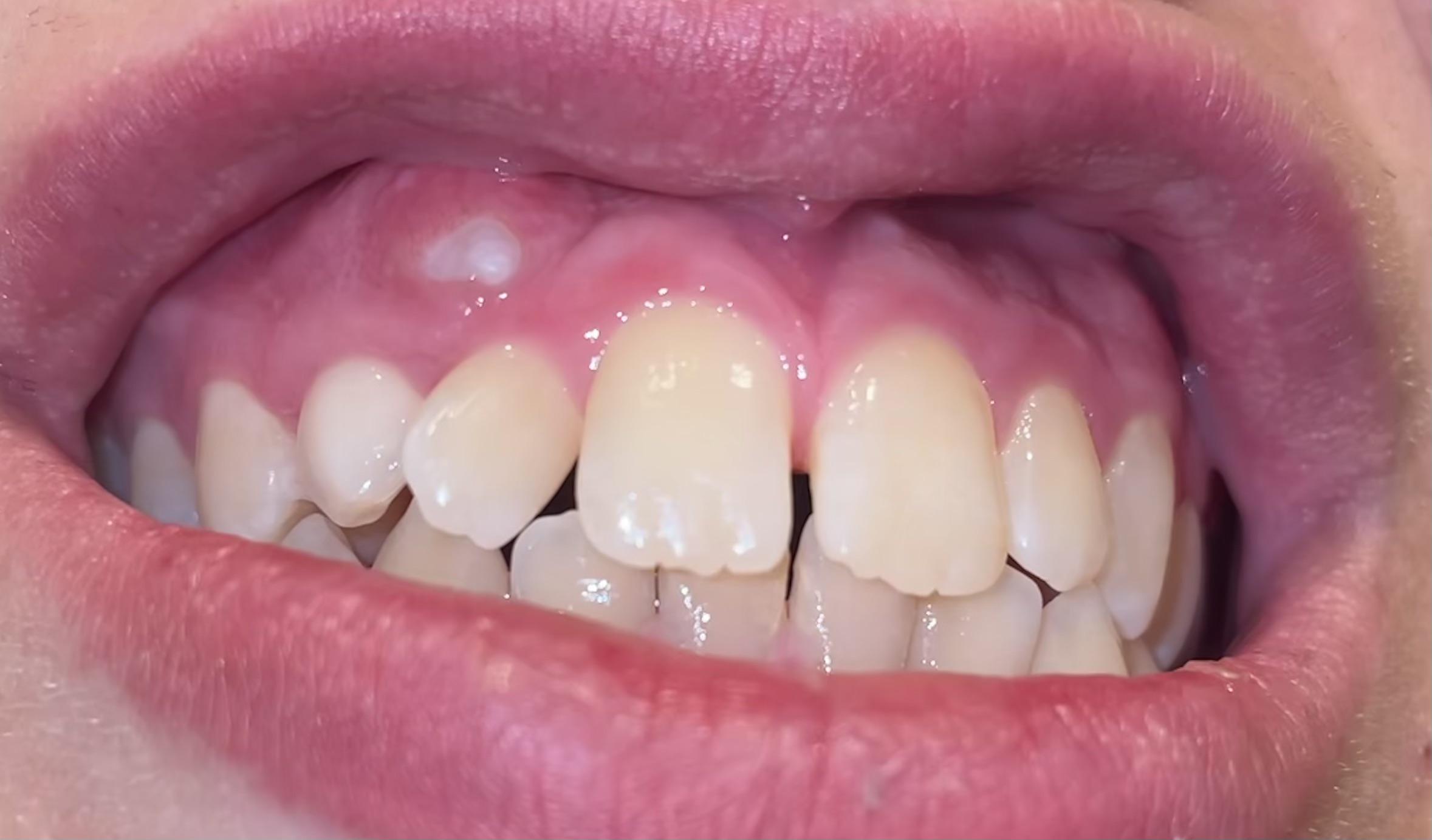 Gums Hurt White Spots