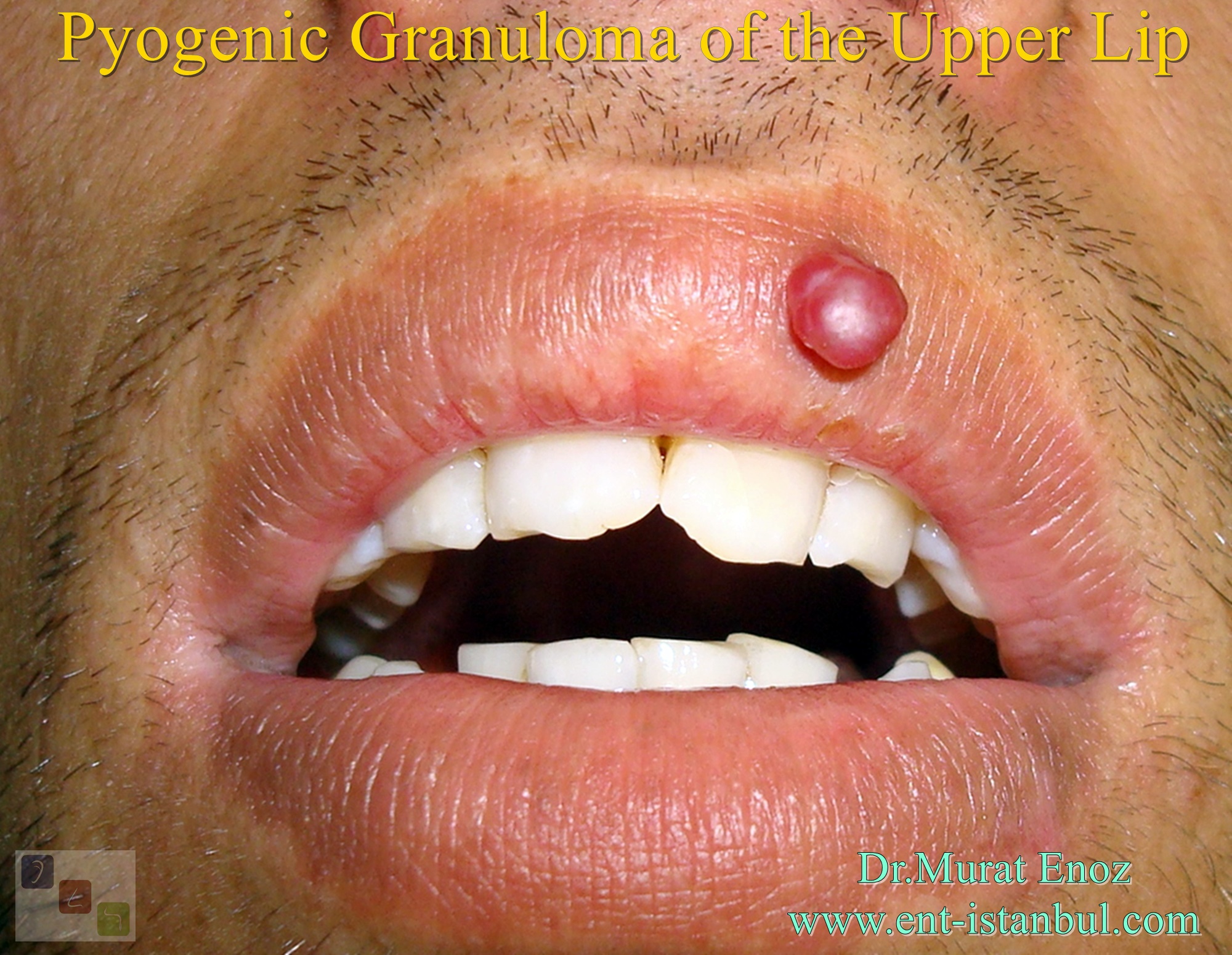 Haemangioma On Lip