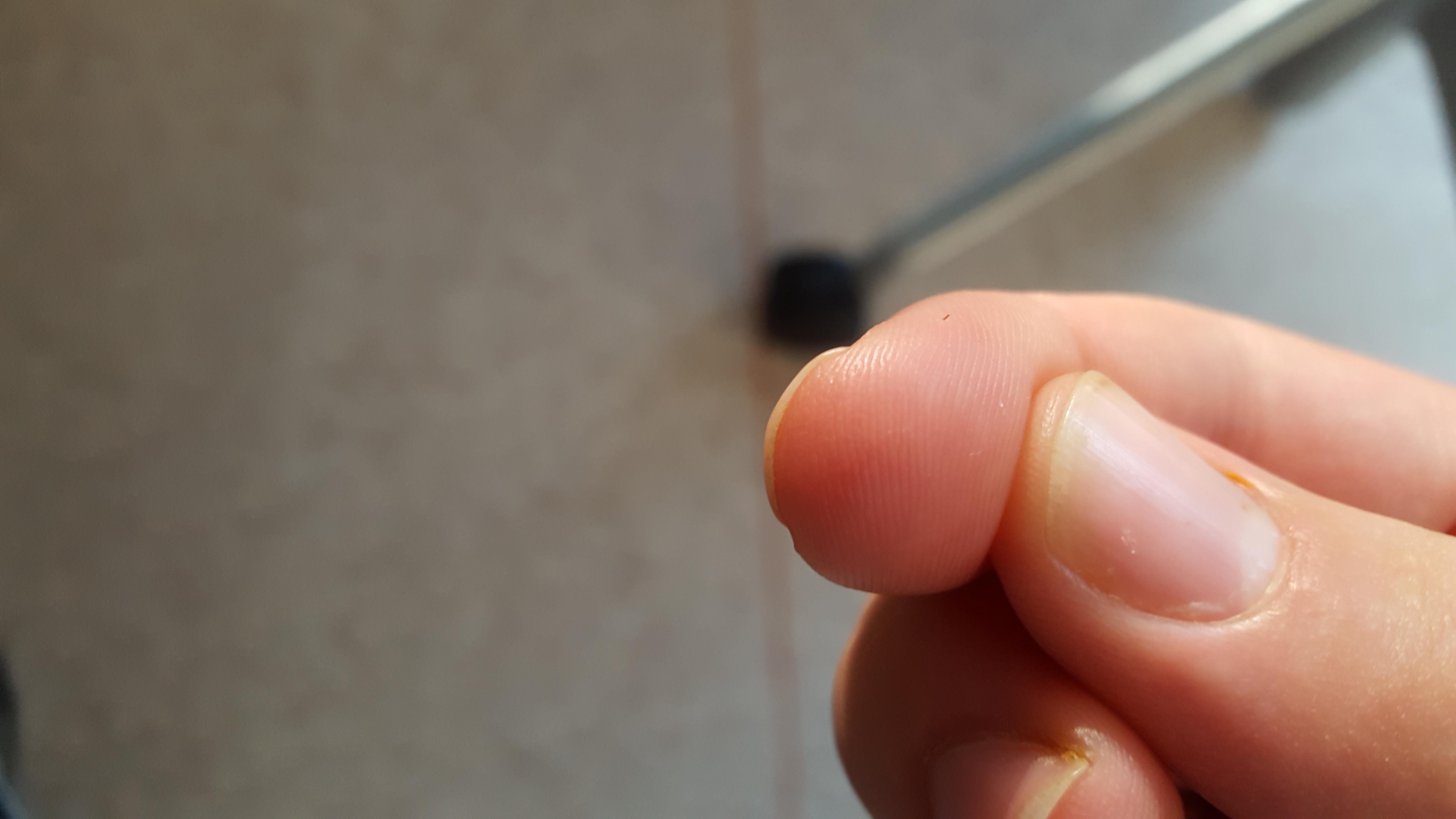 Hair Growing On Thumb
