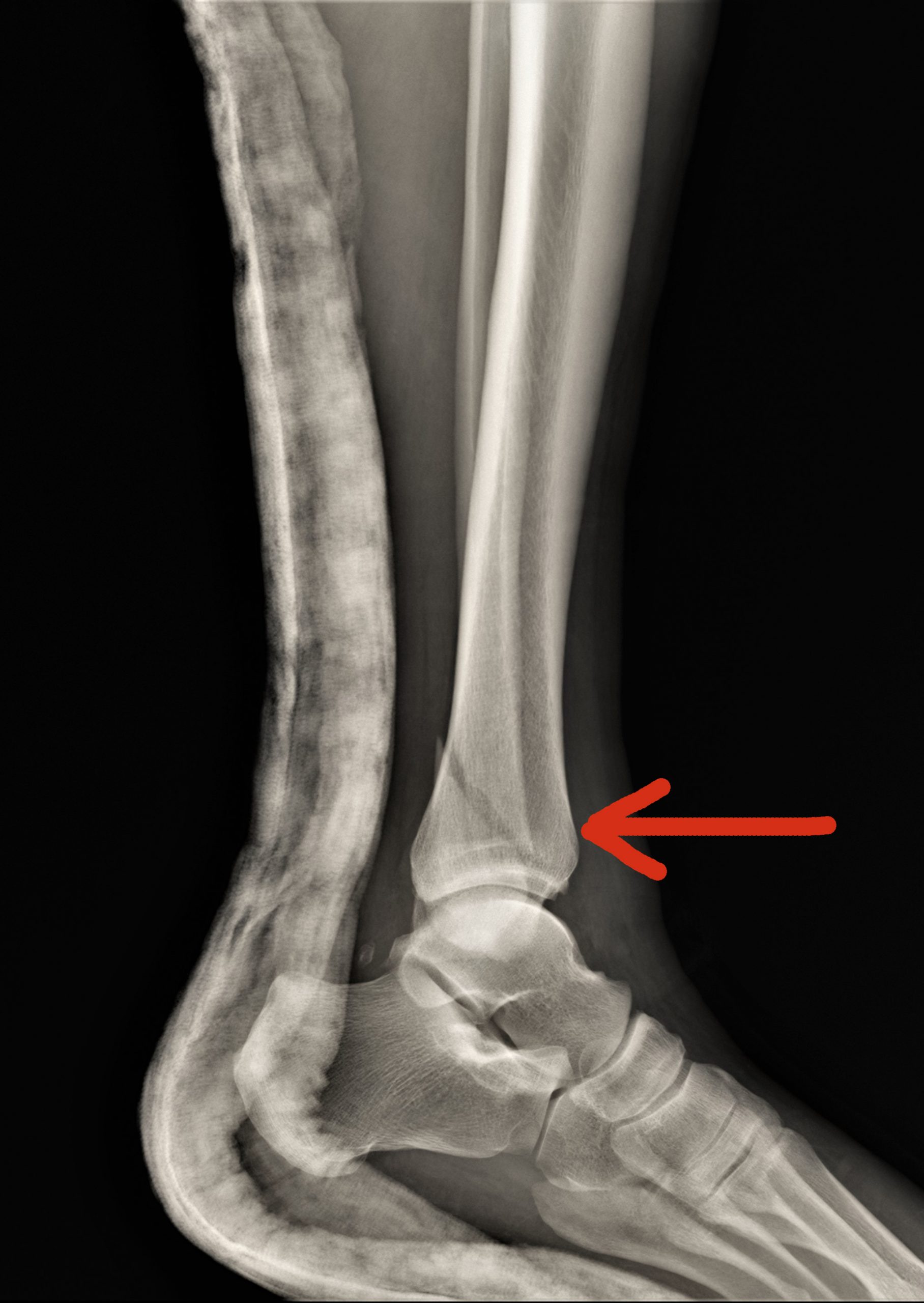 Hairline Fracture Ankle