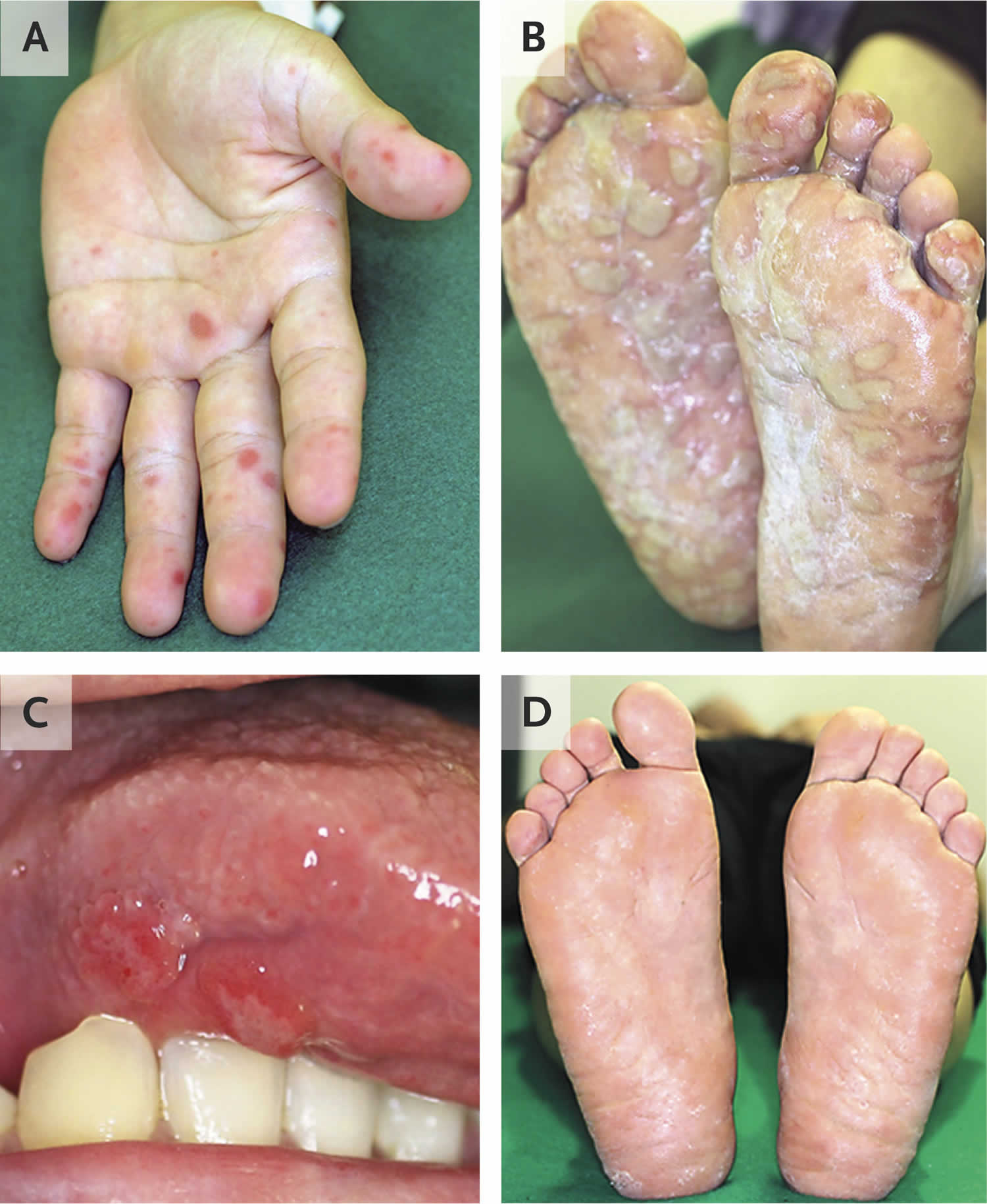 Hand Foot Disease