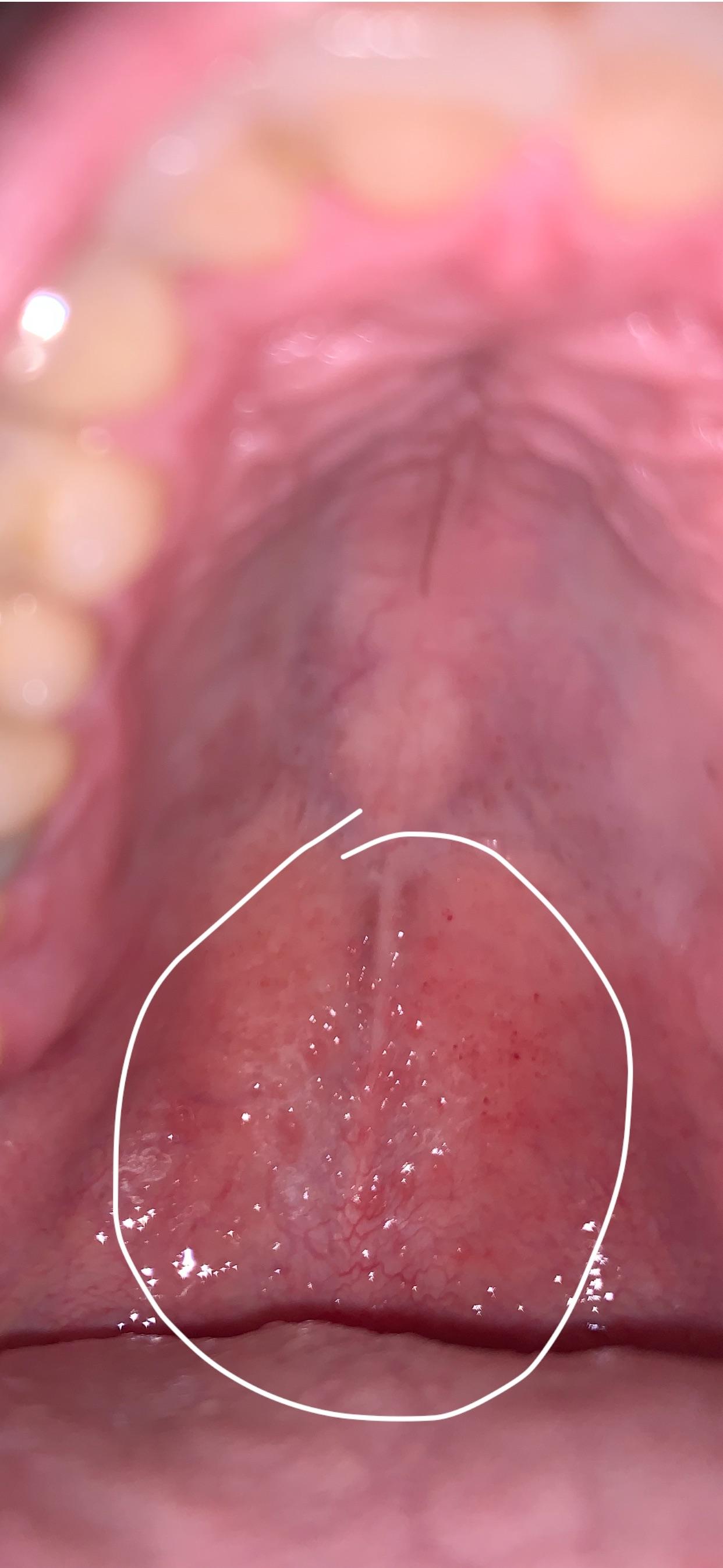 Hard Bump On Mouth Roof