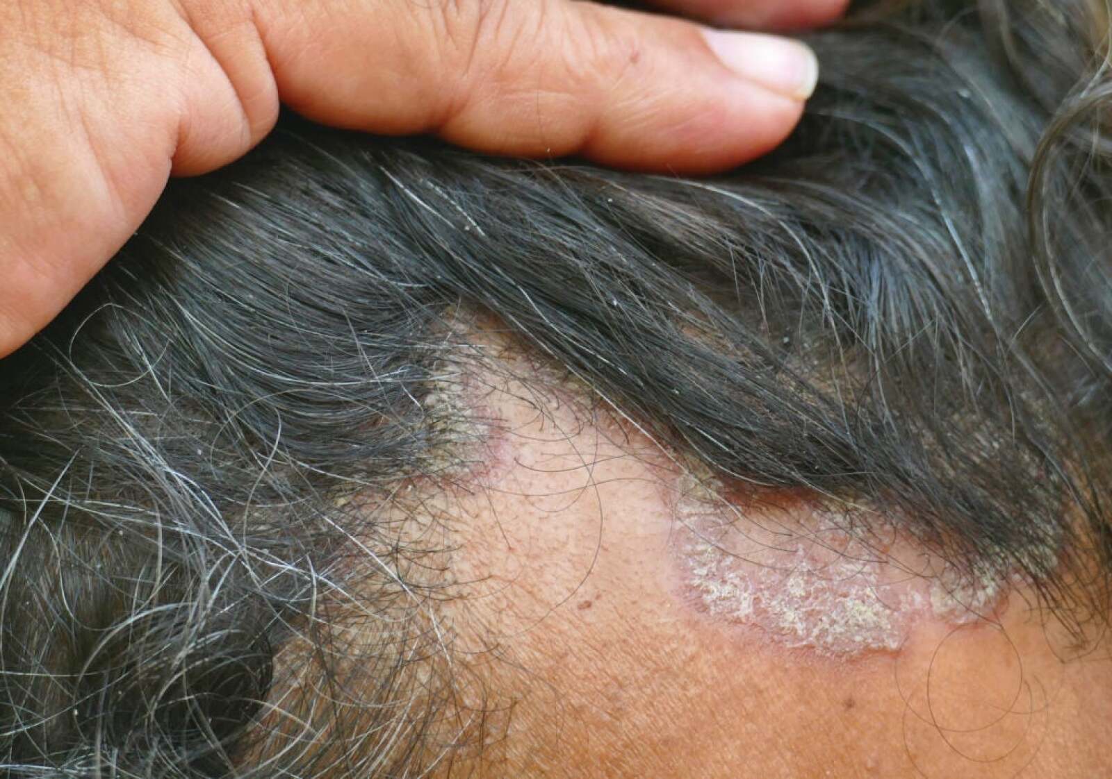 Head Skin Eczema