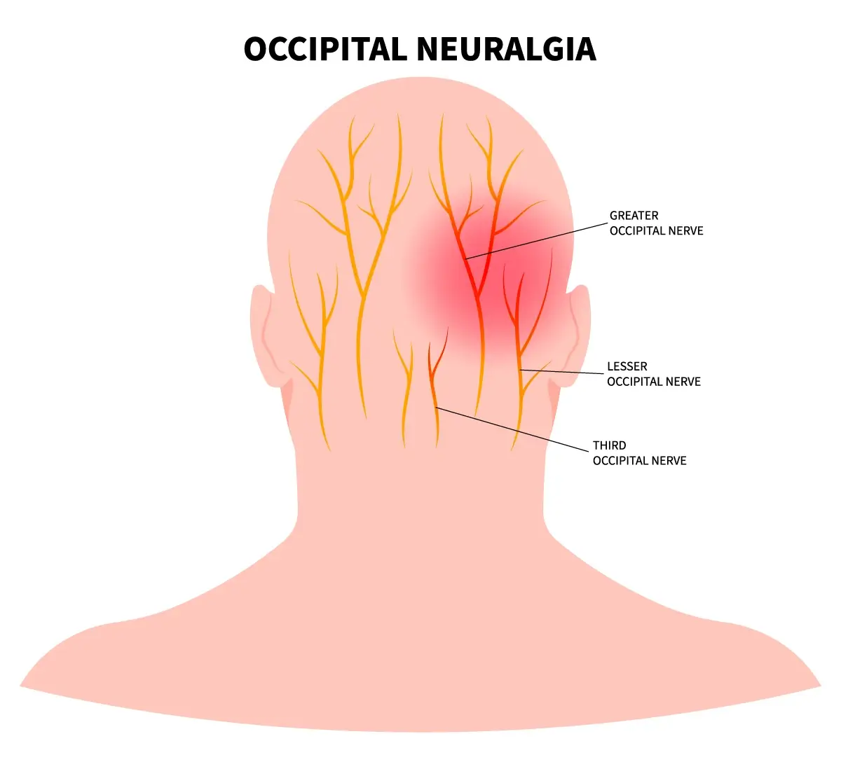 Headache At Base Of Skull