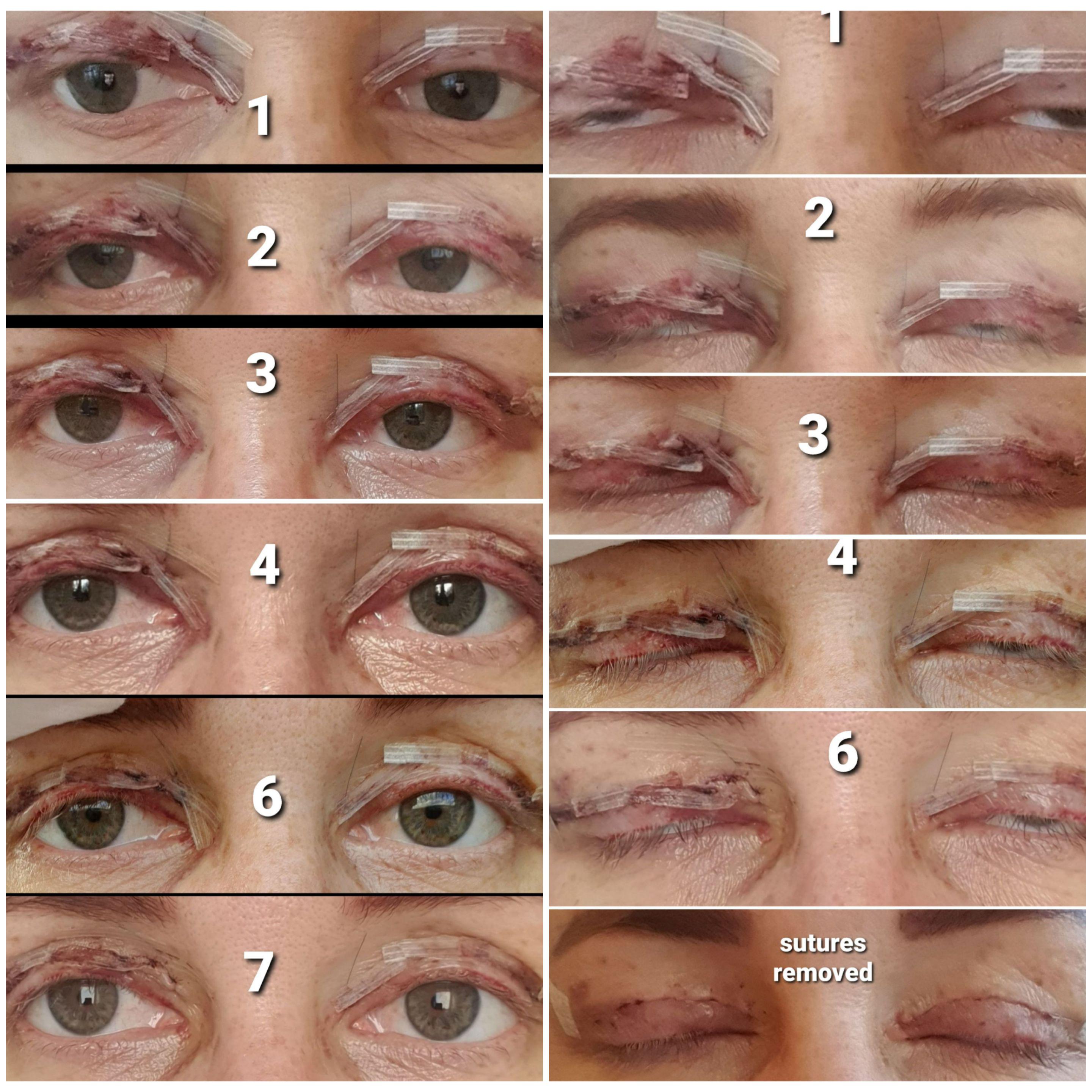 Healing Time Blepharoplasty