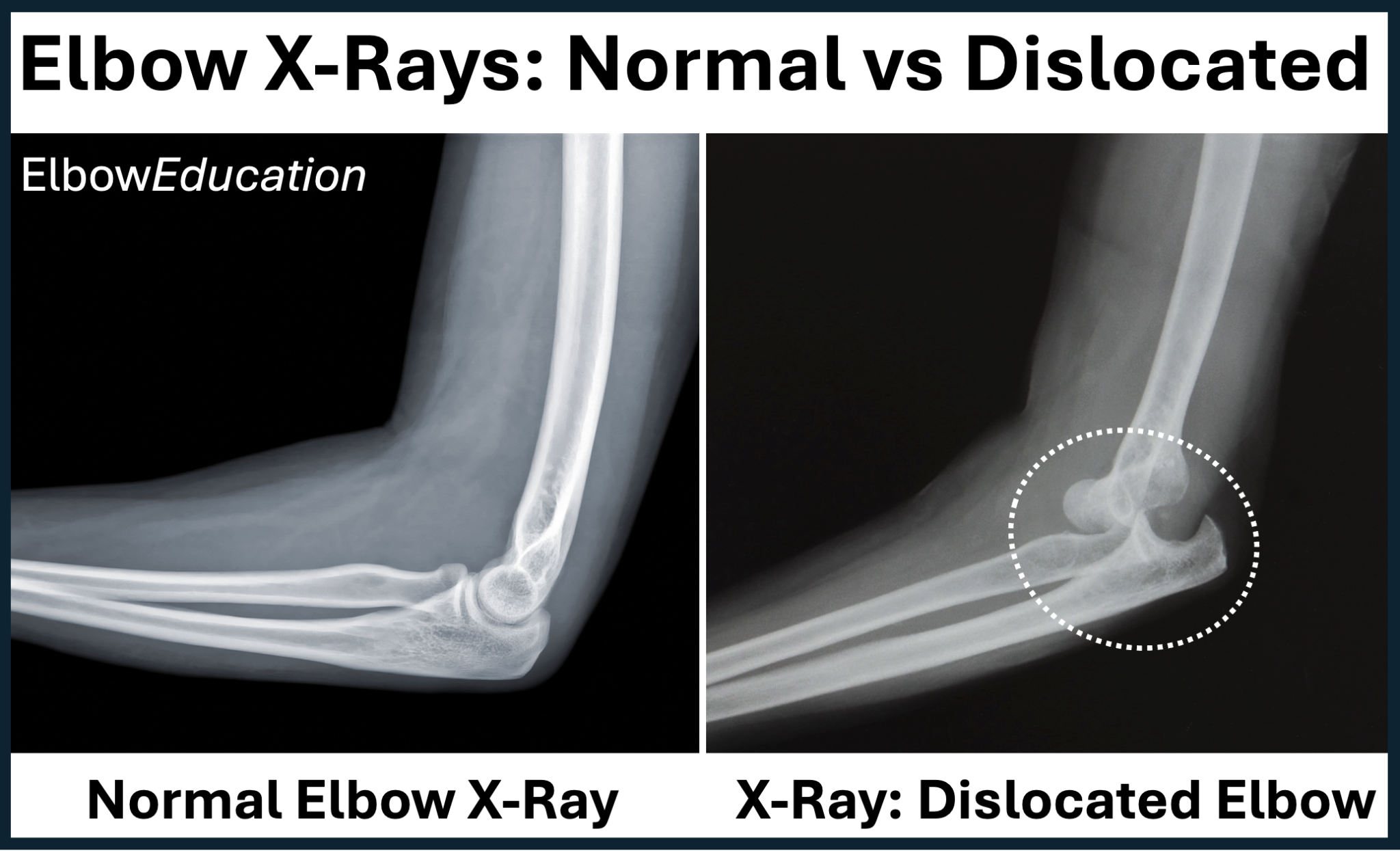 Healing Time For Dislocated Elbow