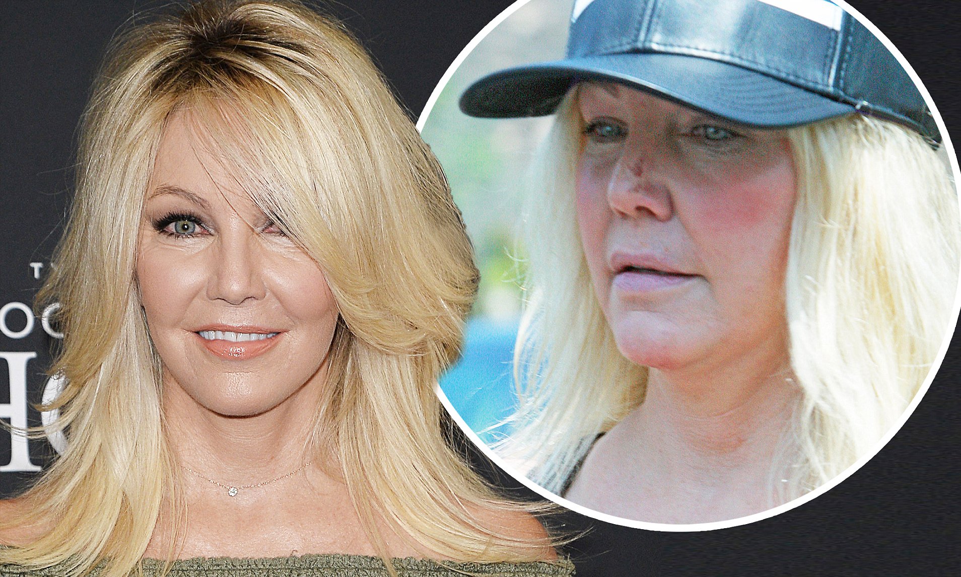 Heather Locklear Face Surgery