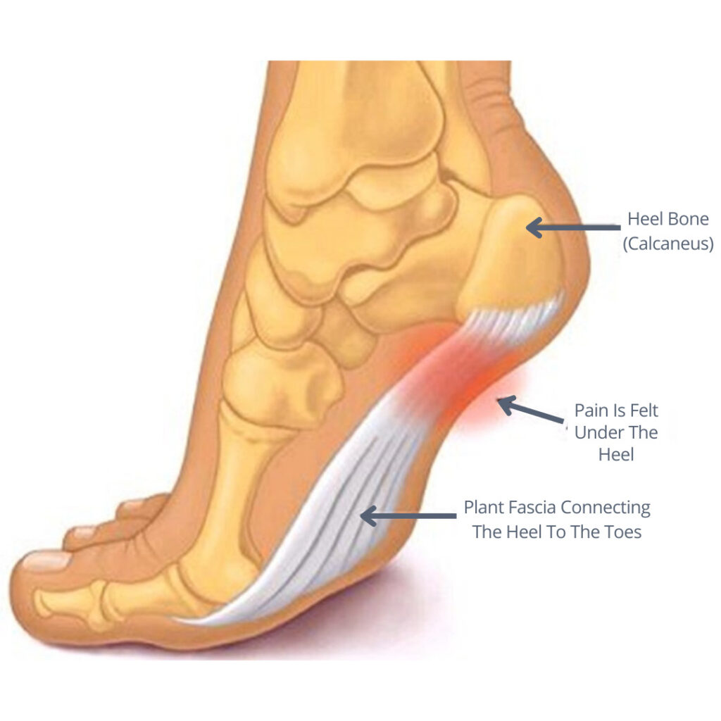 Heel Aches After Running