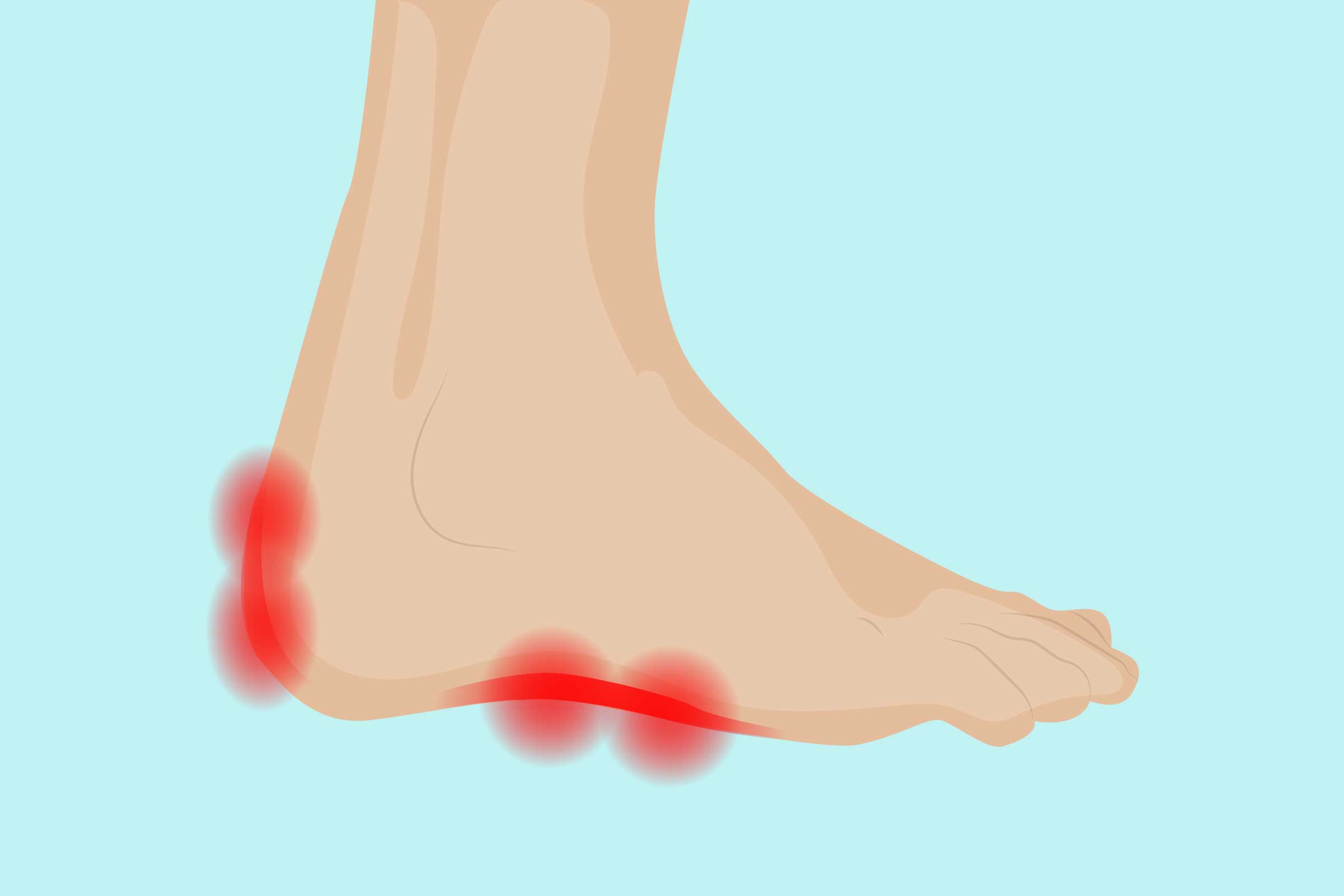 Heel Pain And Burning