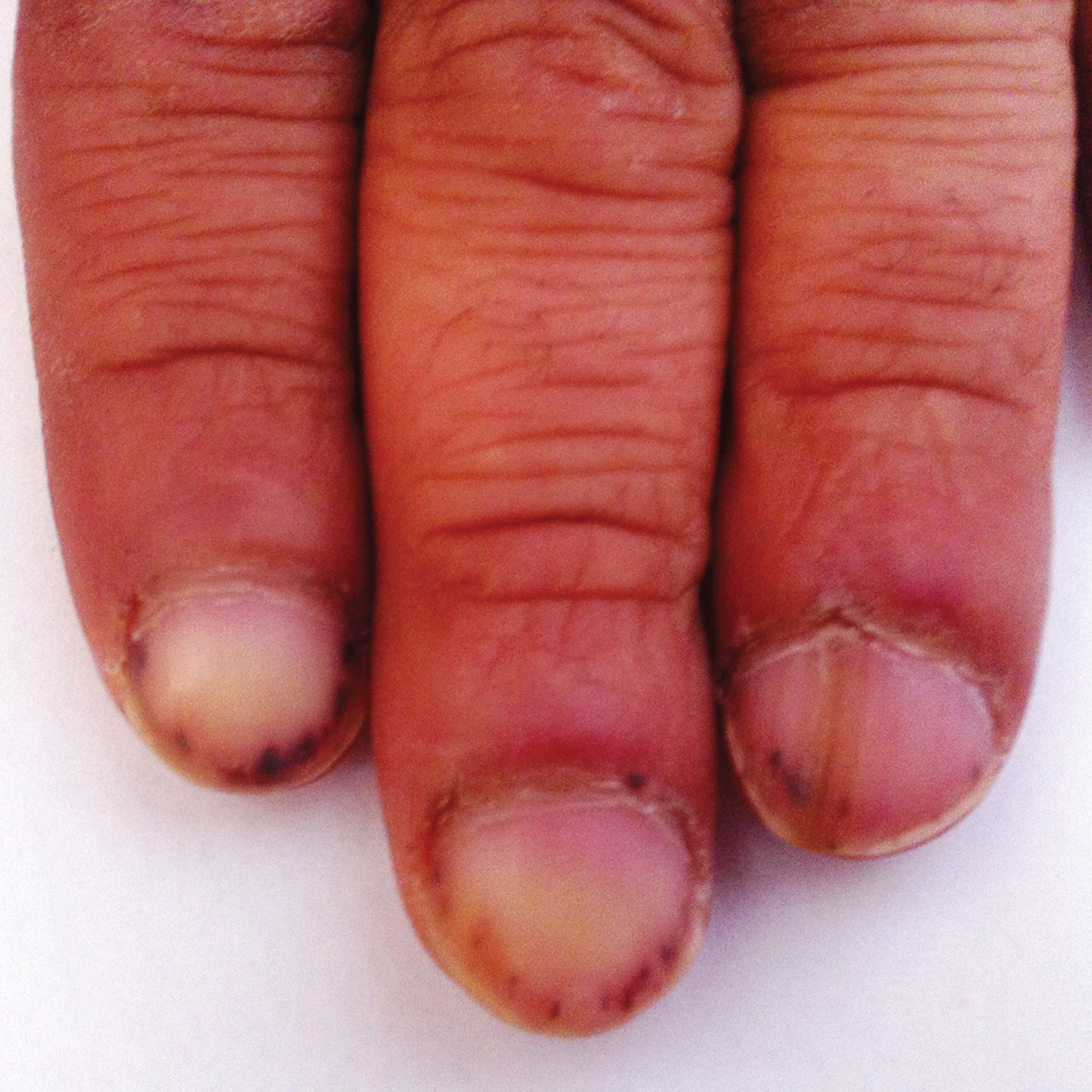 Hemorrhagic Splinters In Nails