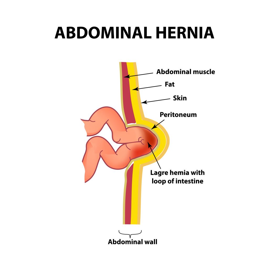 Hernia Belly Button