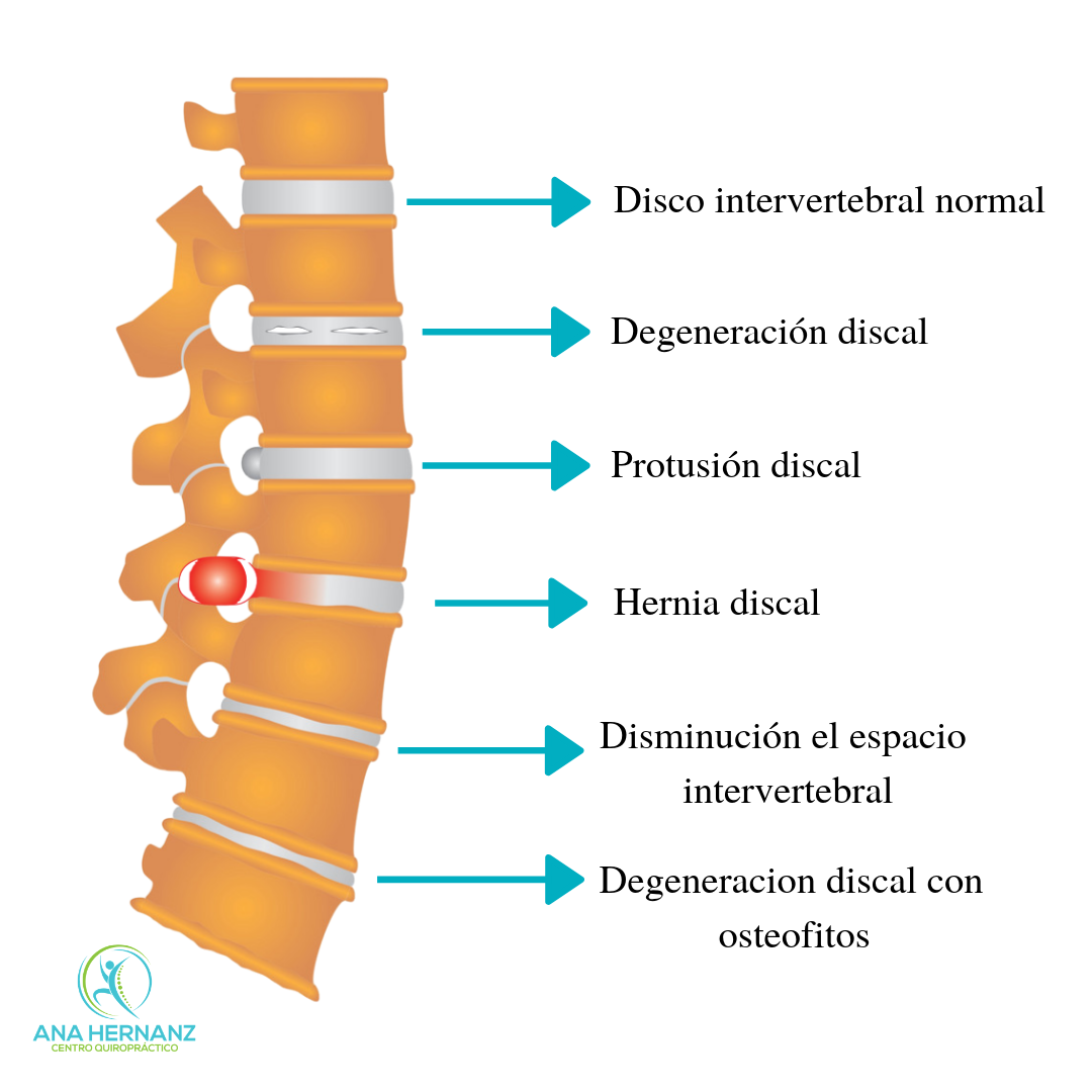Hernia Discal Lumbar