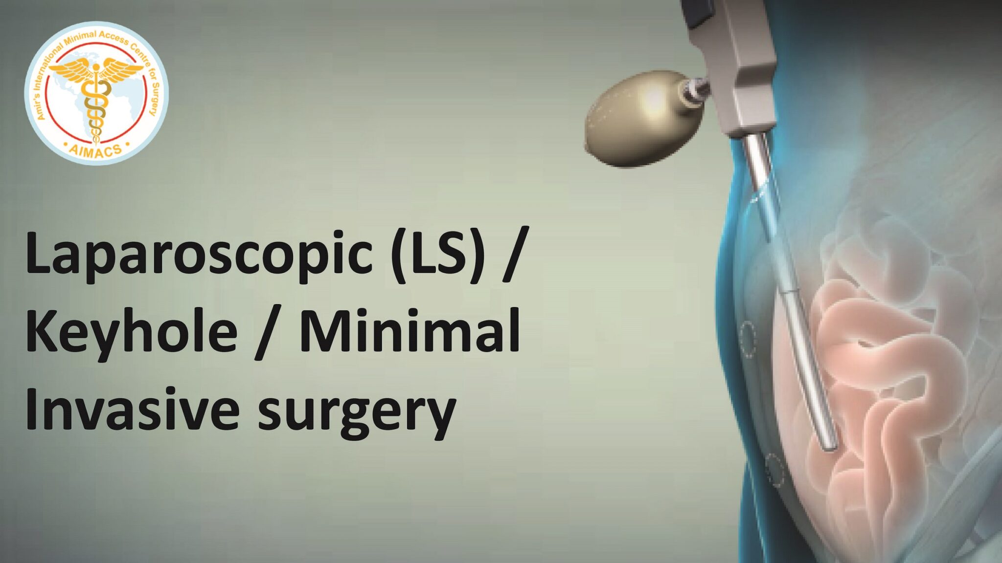 Hernia Laparoscopic Recovery Time