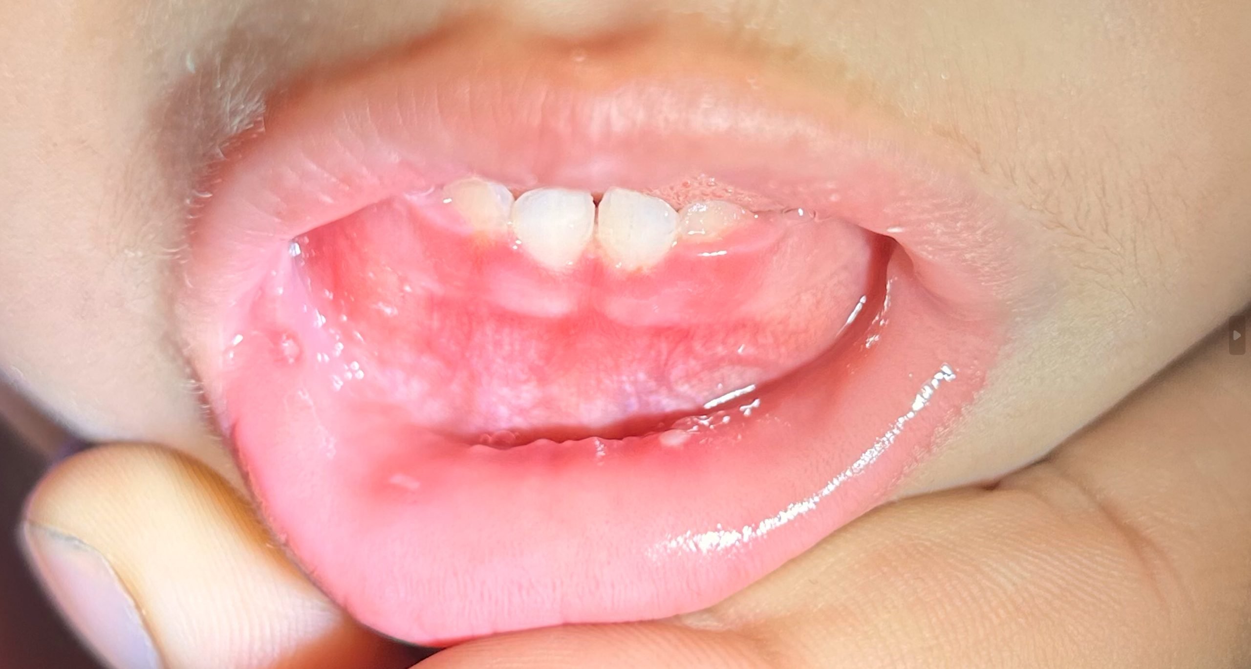 Herpes And Gums