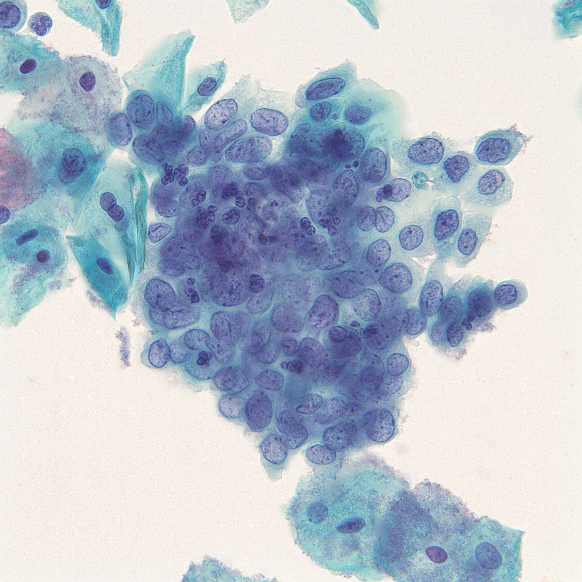 High Grade Squamous Intraepithelial Lesion