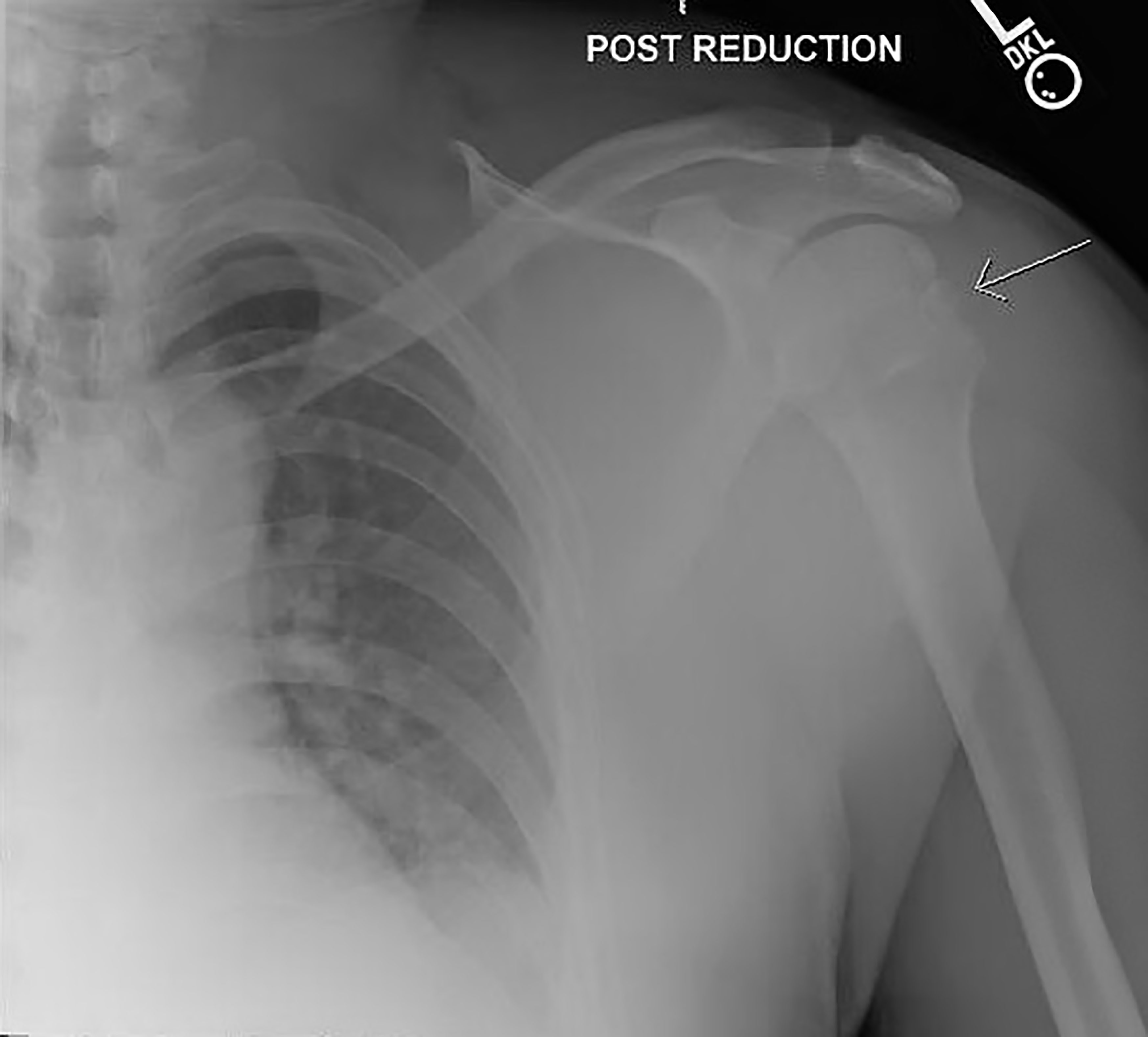 Hill Sachs Deformity