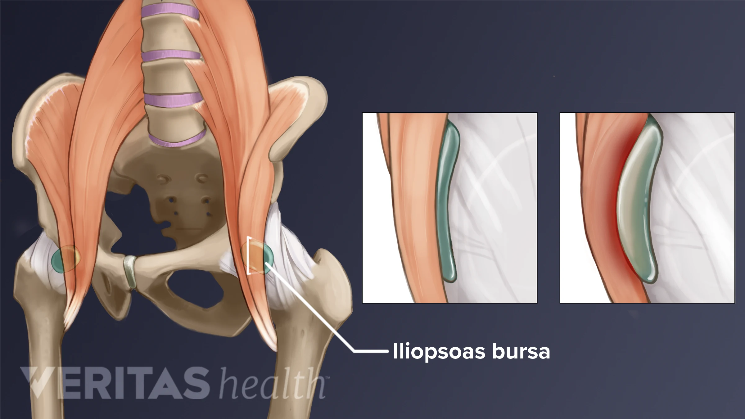 Hip Bursitis Symptoms