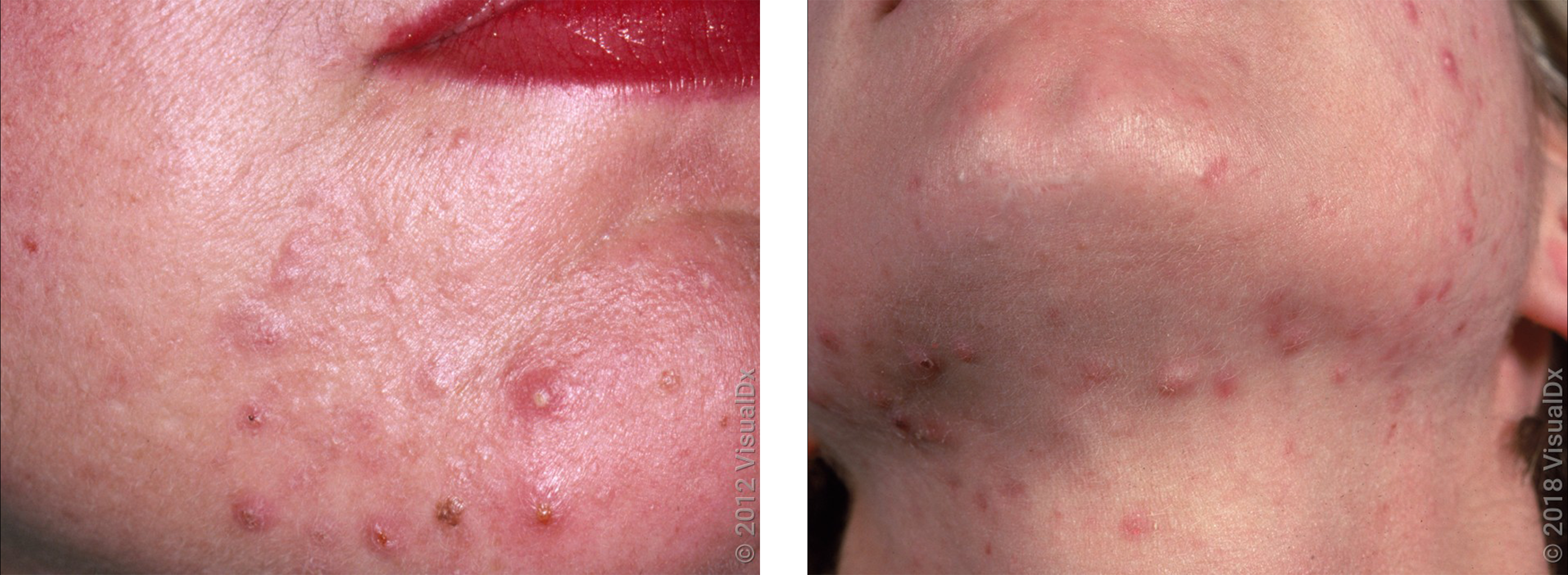 Hormonal Acne On Chin
