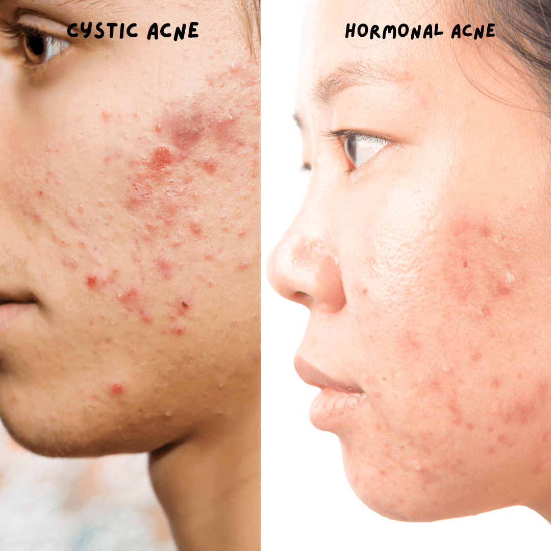 Hormonal Cystic Pimple