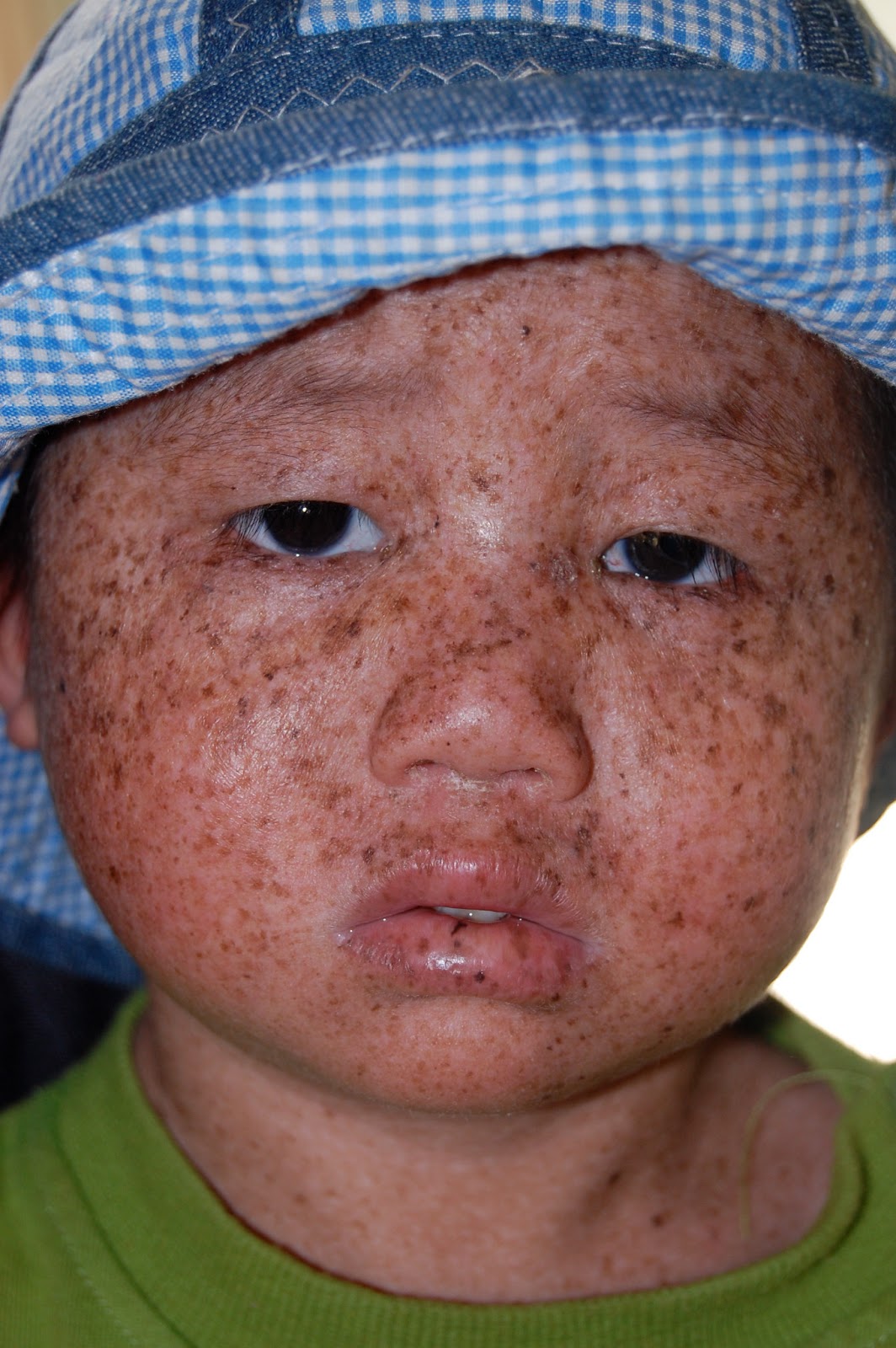 How Common Is Xeroderma Pigmentosum