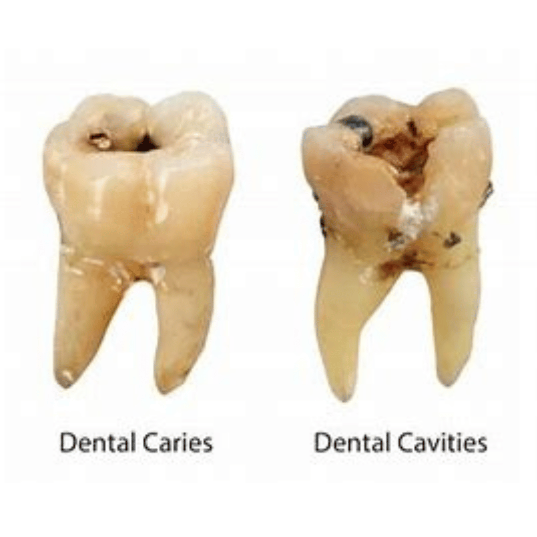 How Do Cavities Look Like