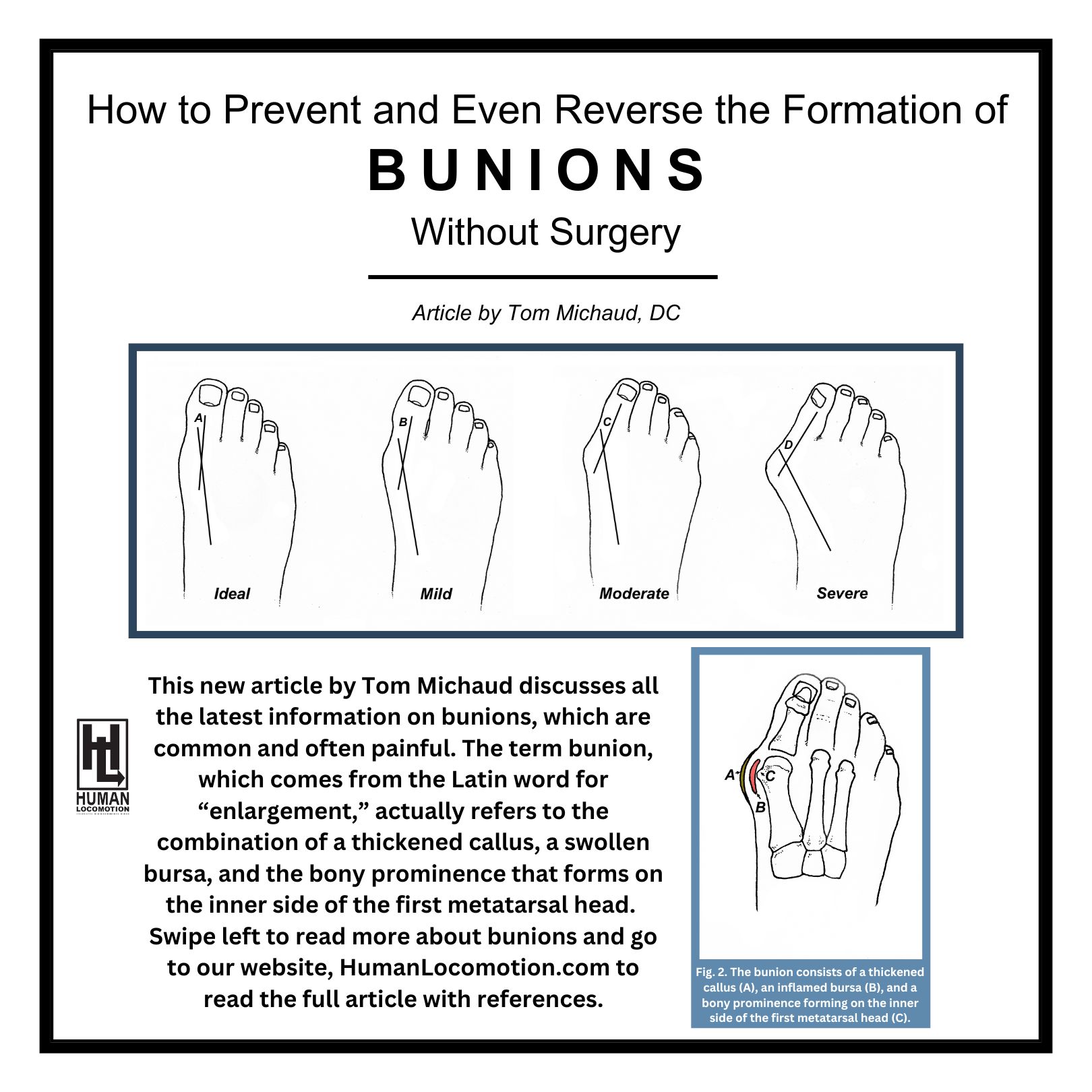 How Do I Prevent Bunions