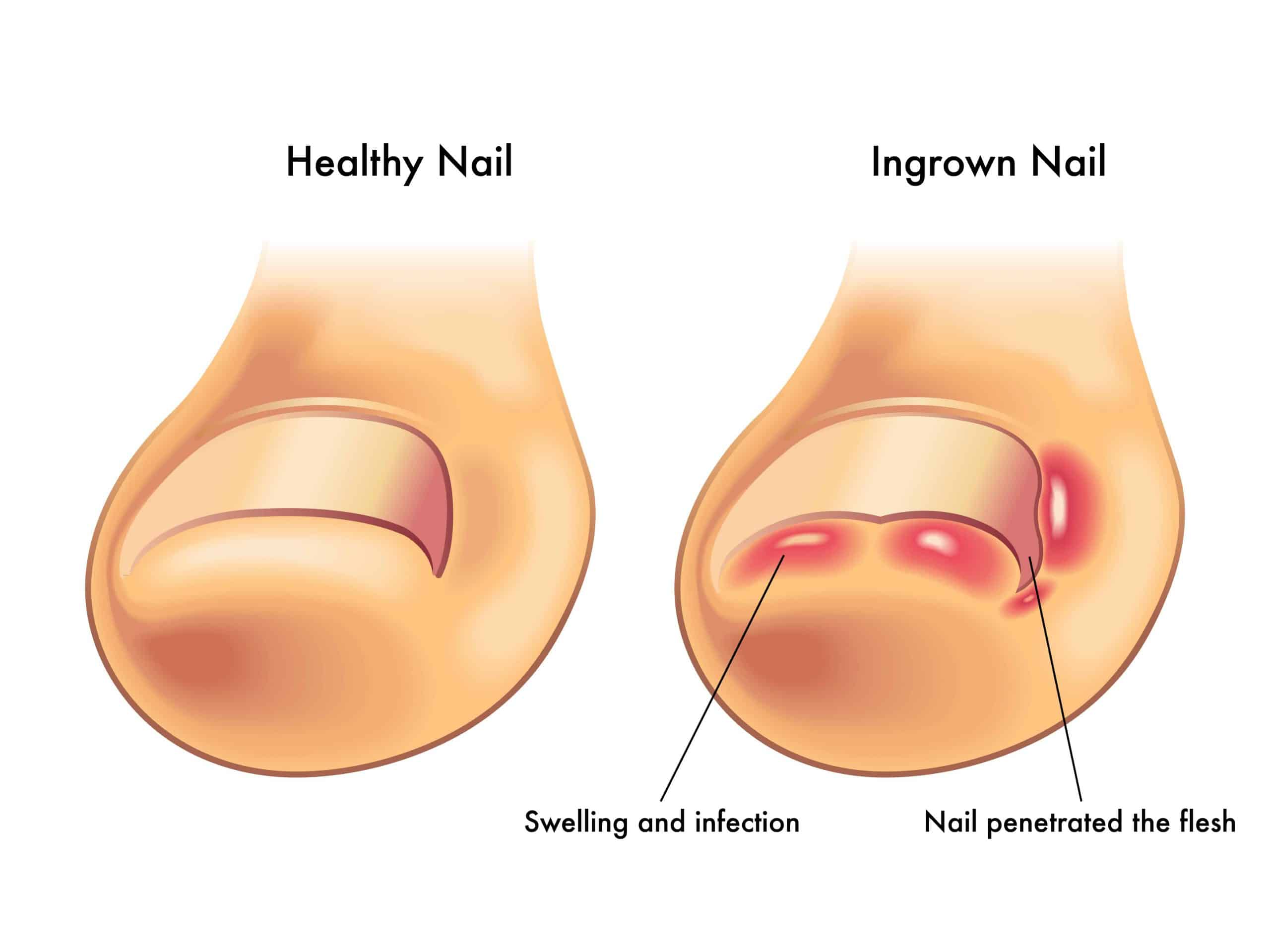 How Do Ingrown Toenails Occur
