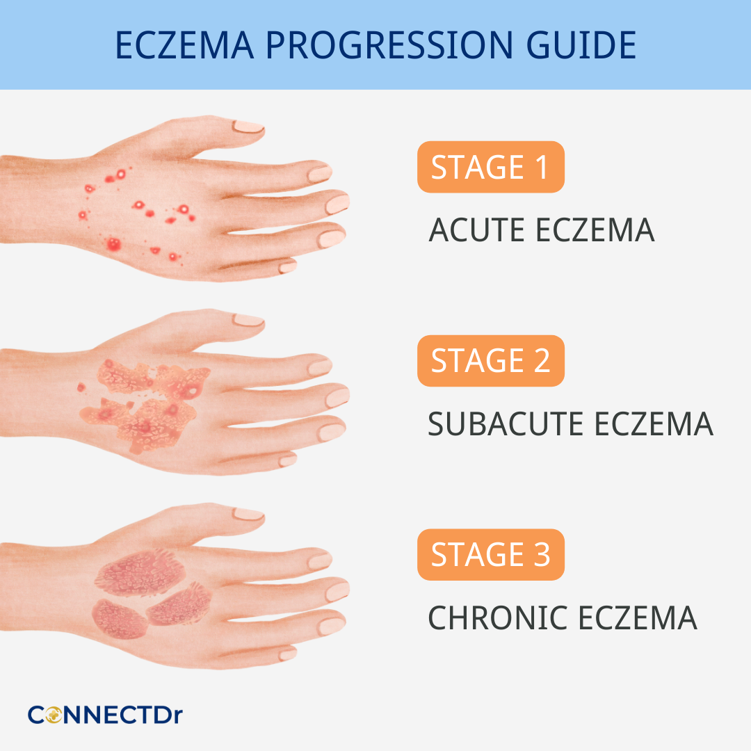 How Do You Get Eczema