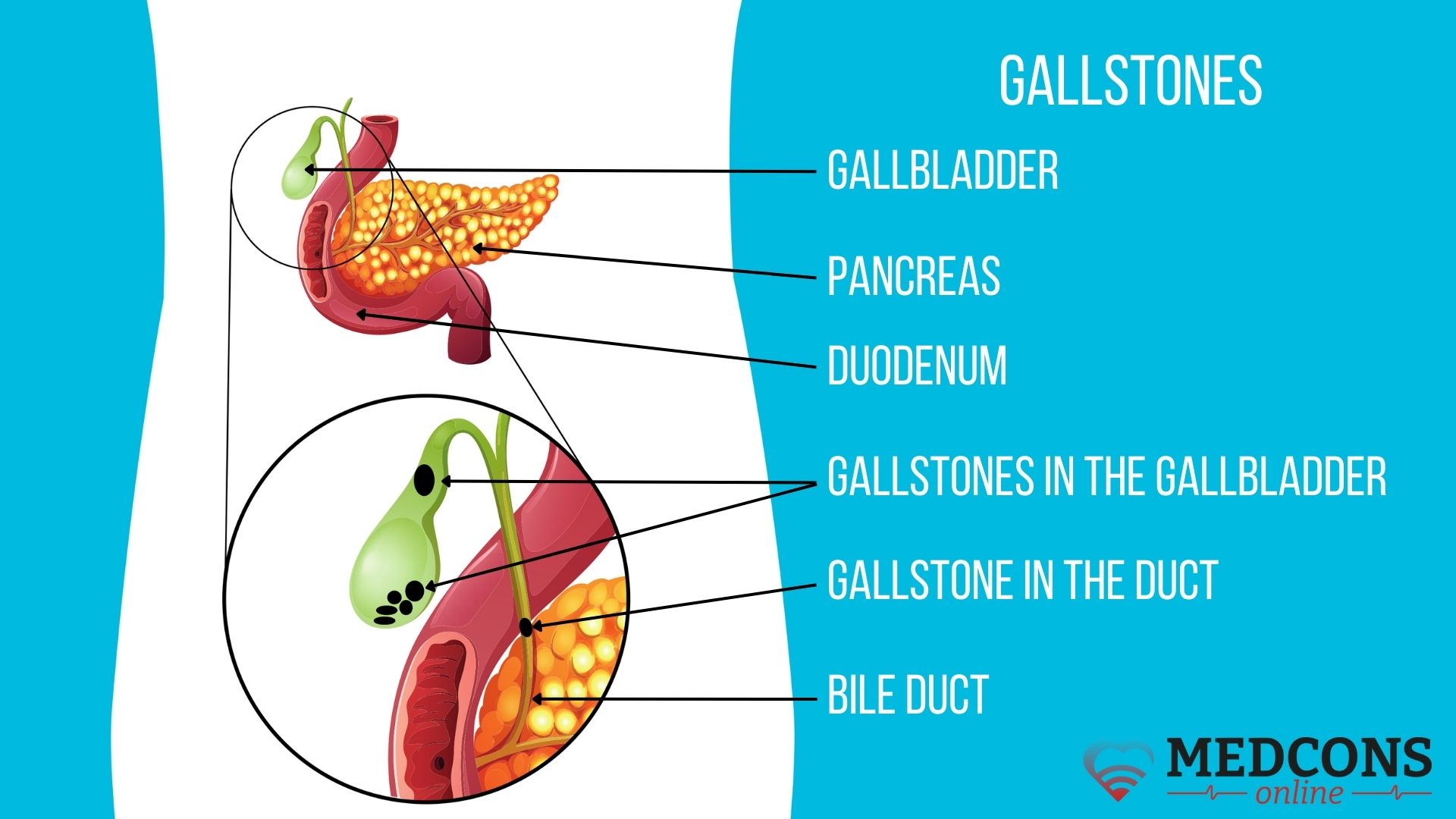 How Do You Get Gallstones
