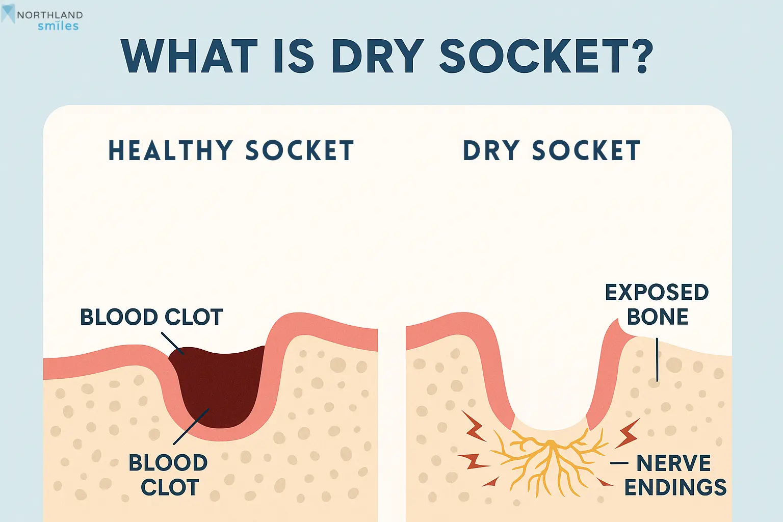 How Does Dry Socket Look