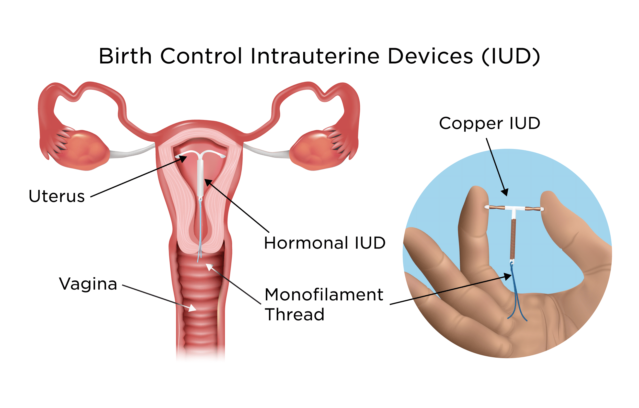 How Effective Are Iuds