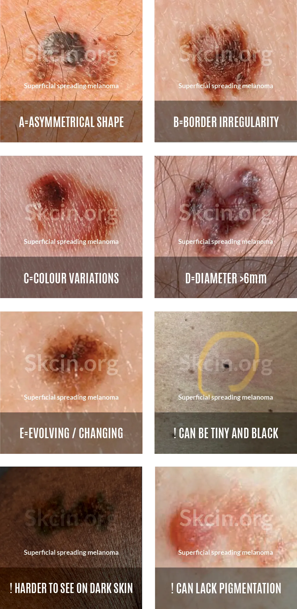 How Fast Does Melanoma Grow