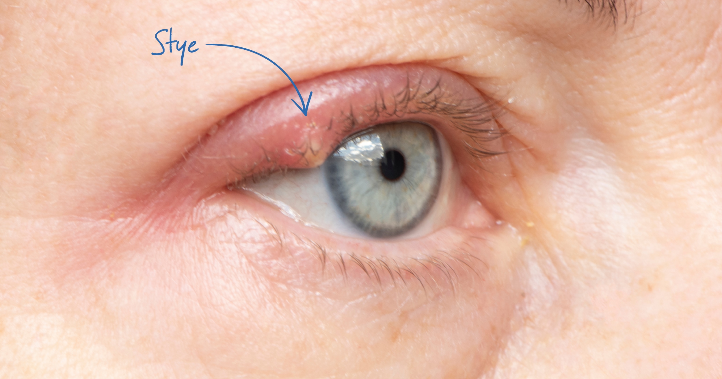 How Long Do Styes Last