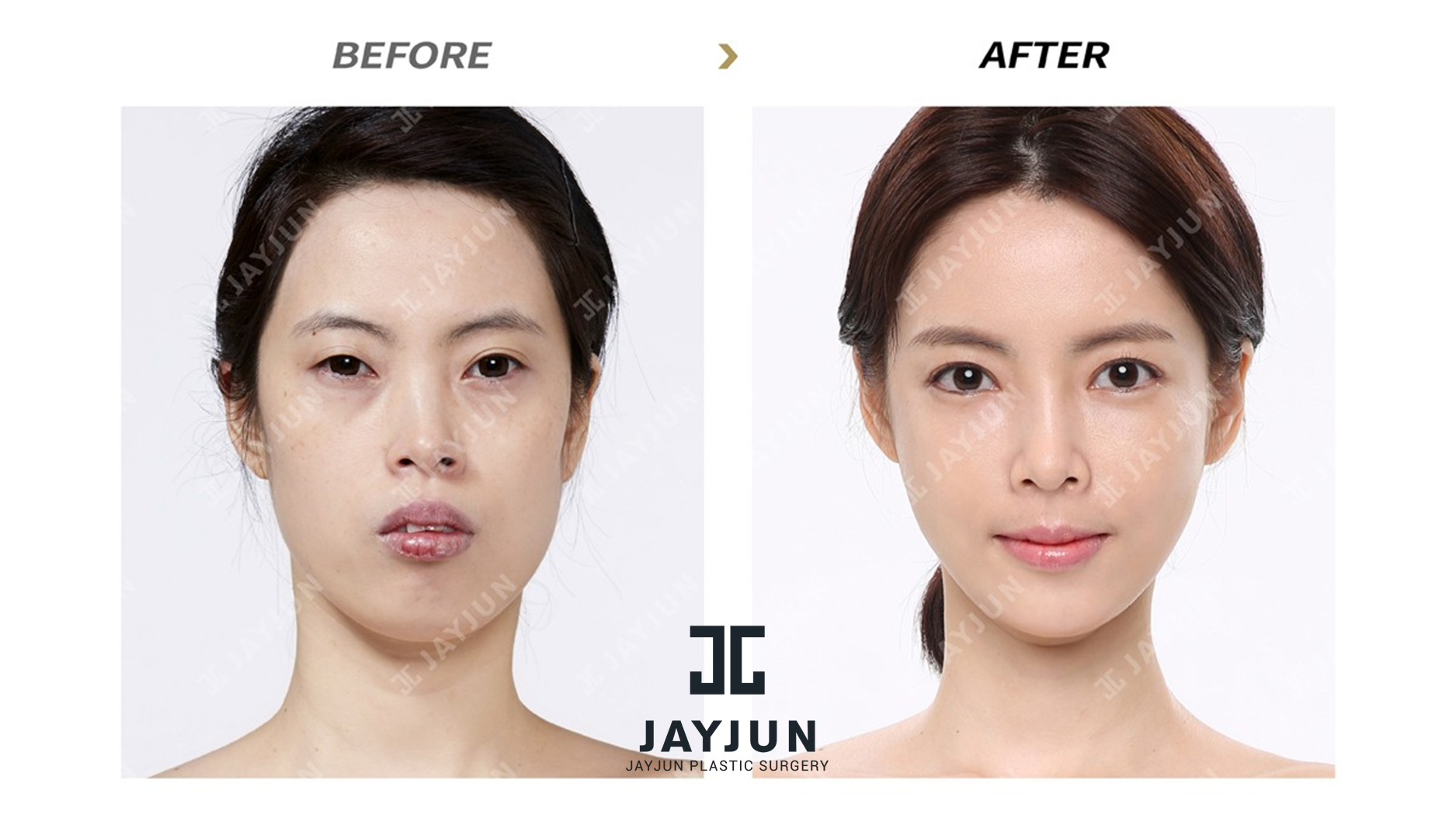 How Much Does Face Surgery Cost In Korea