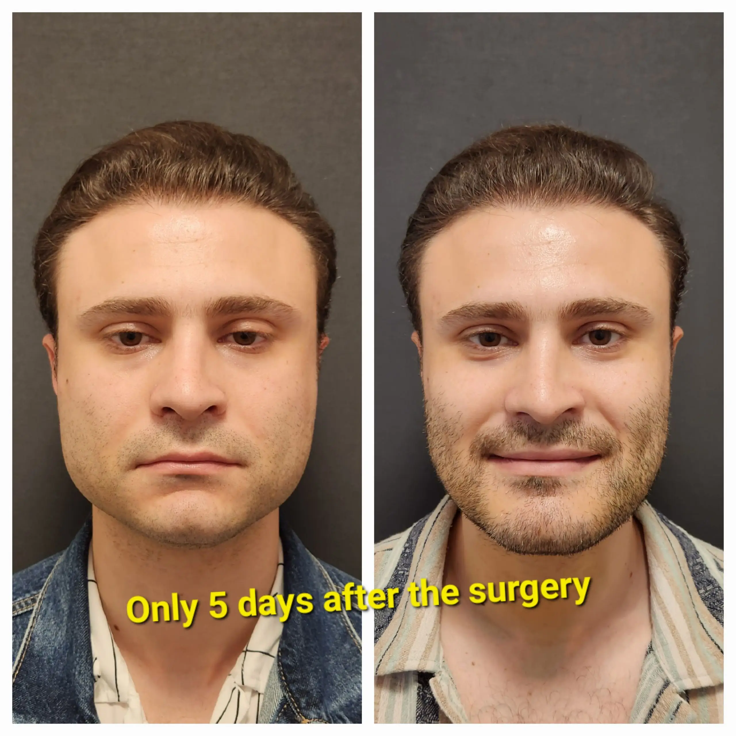 How Much Does Face Surgery Cost