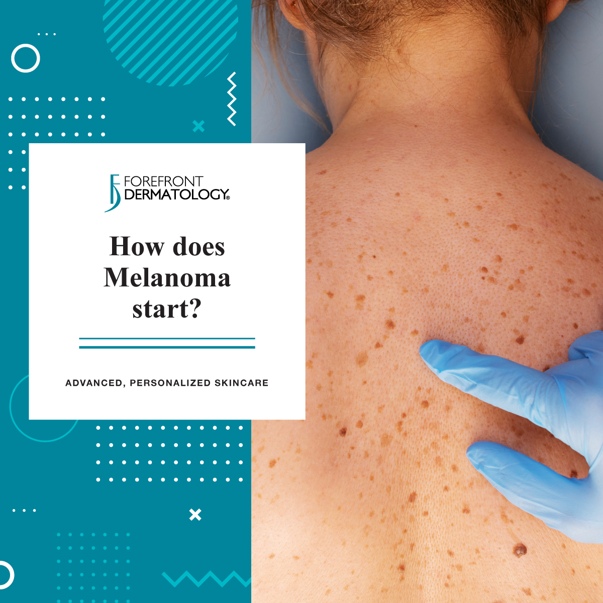 How Quickly Does Melanoma Spread