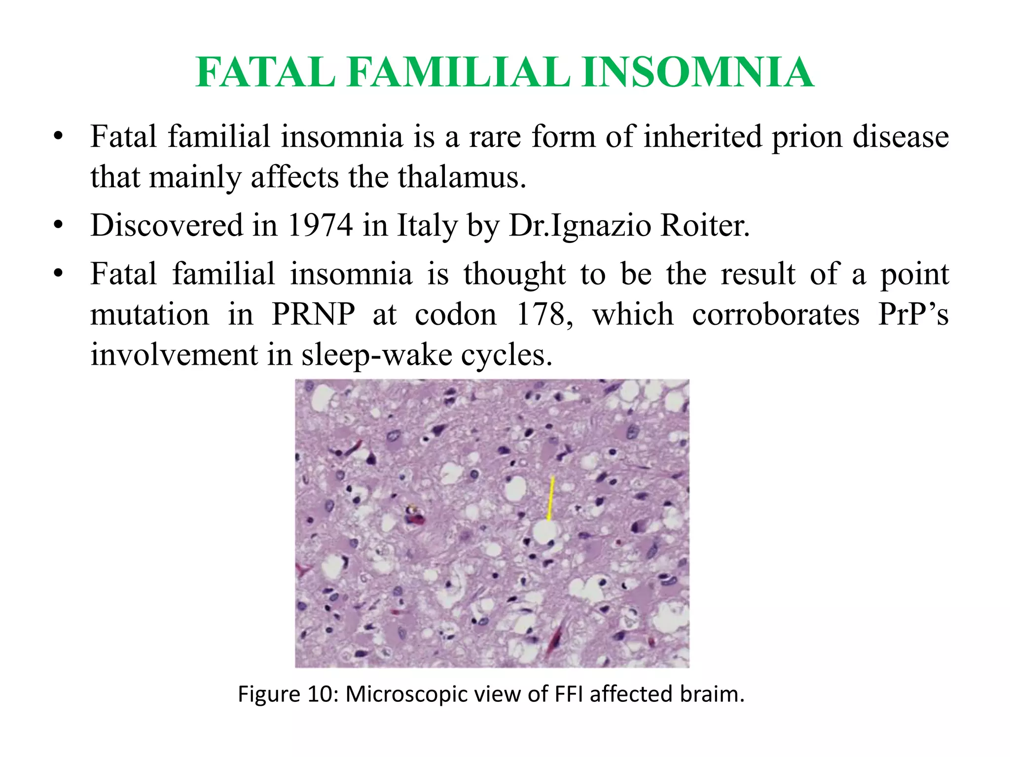 How Rare Is Fatal Insomnia