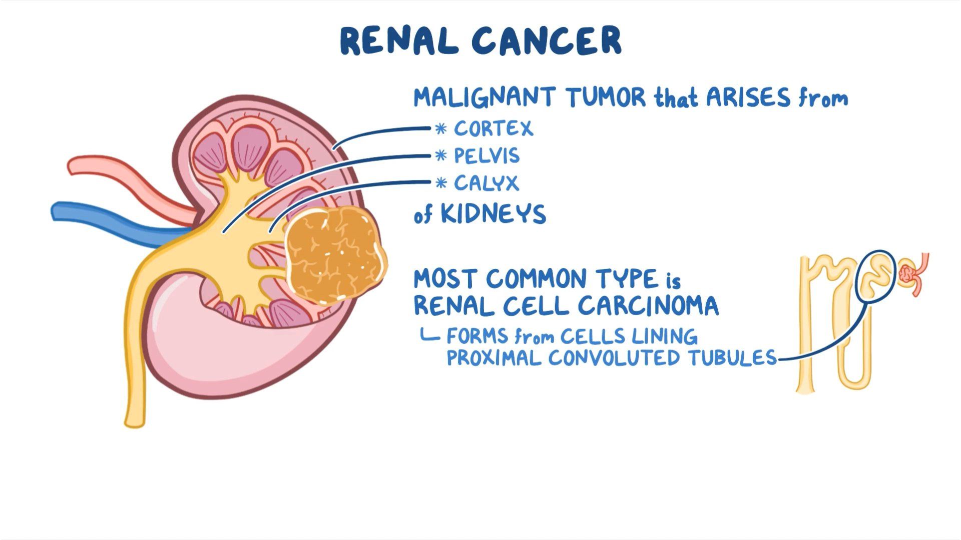 How Rare Is Kidney Cancer