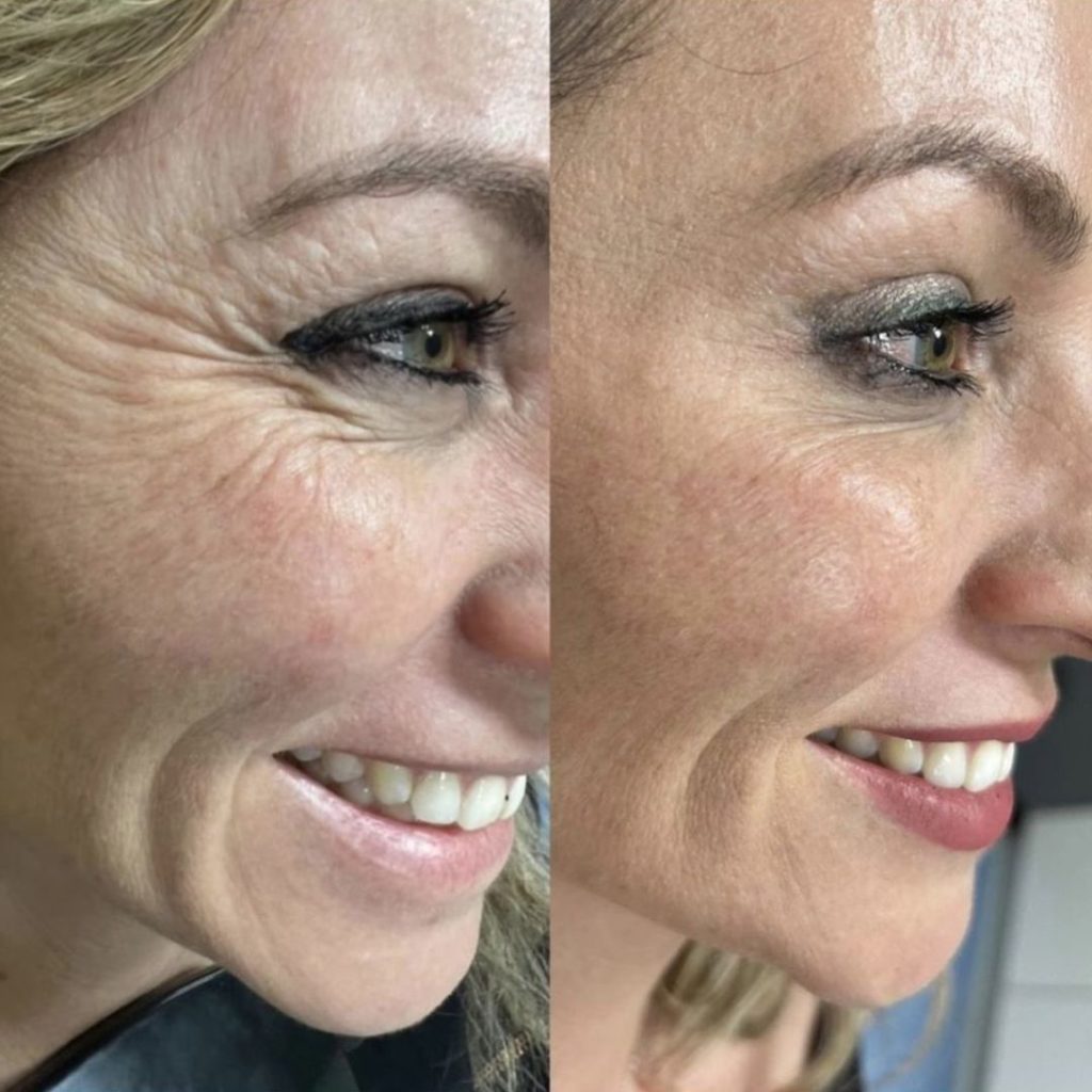 How To Avoid Forehead Lines