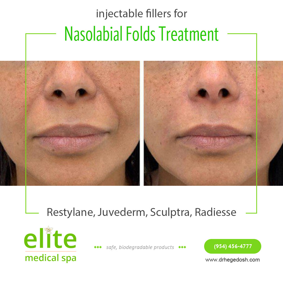 How To Eliminate Nasolabial Folds