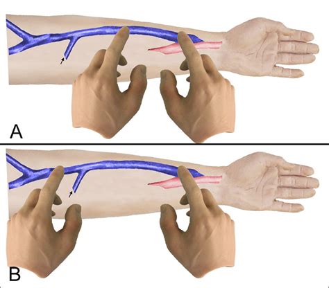 How to Examine a Vascular Access: Part 2 The Physical Exam - Renal ...